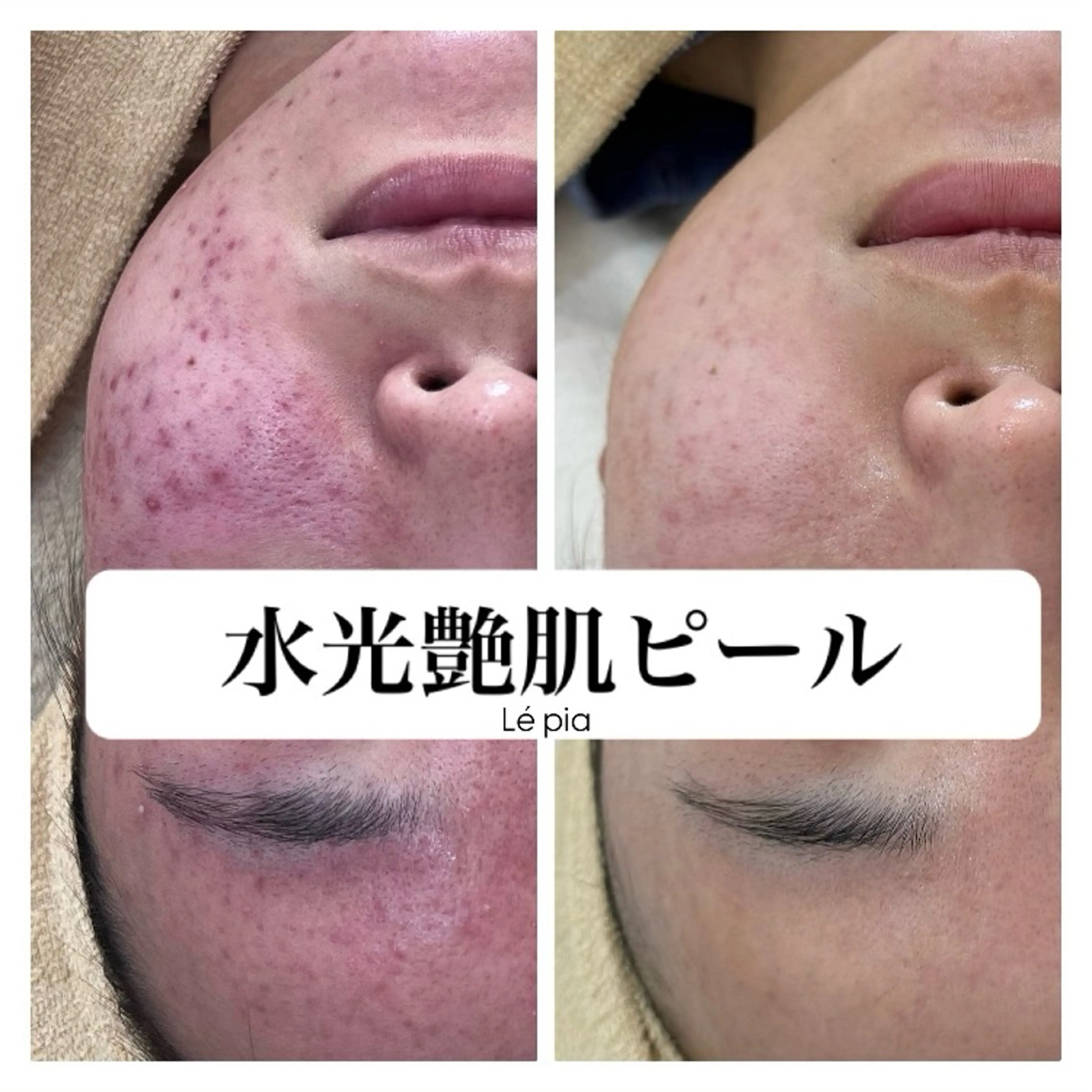 エステ リラク 肌質管理専門店 Lé pia　AMIのエステ・リラクイメージ