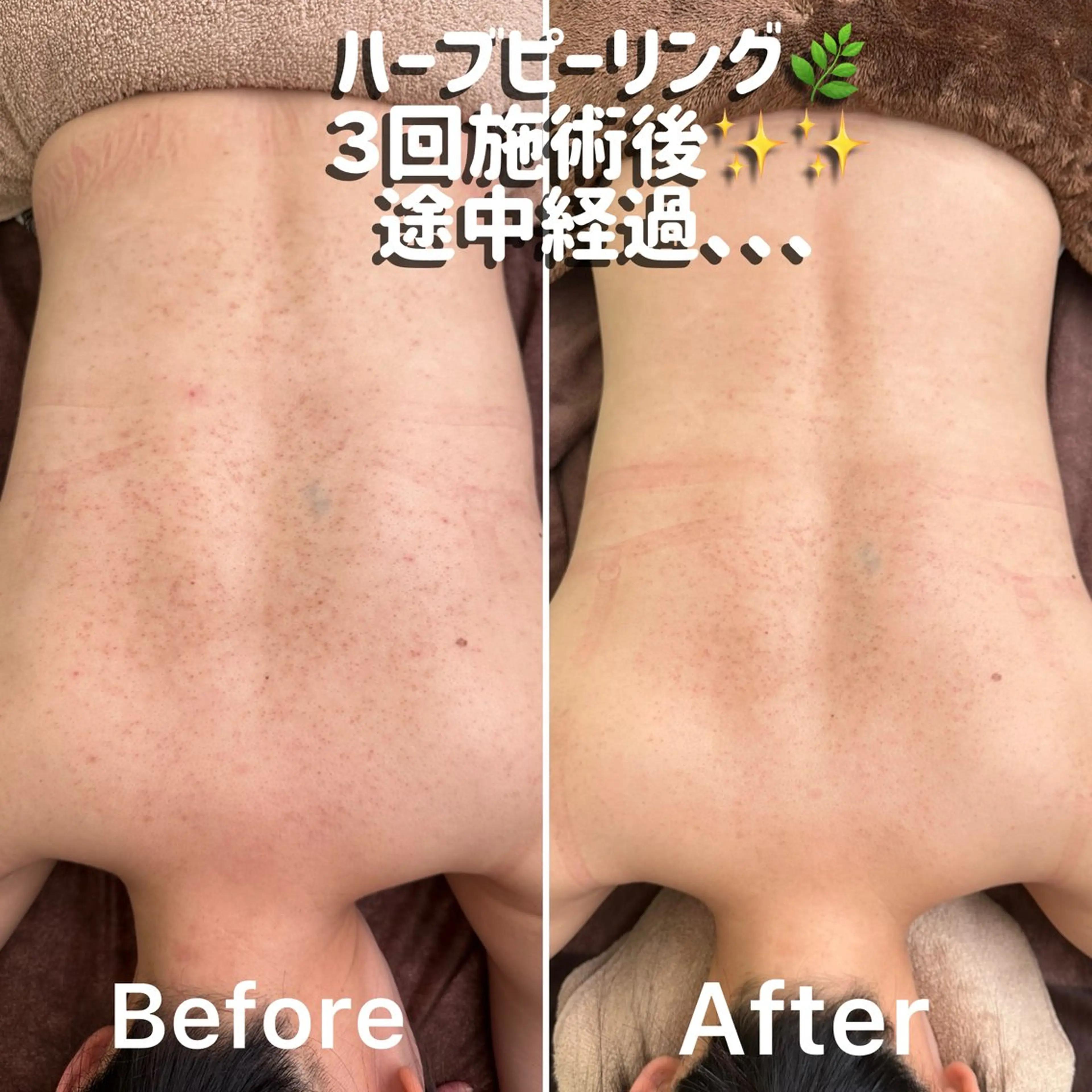 【ボディリベルハーブピーリング1部位】背中上・背中下・デコルテ・二の腕・おしり・ひじひざ・お腹などの写真