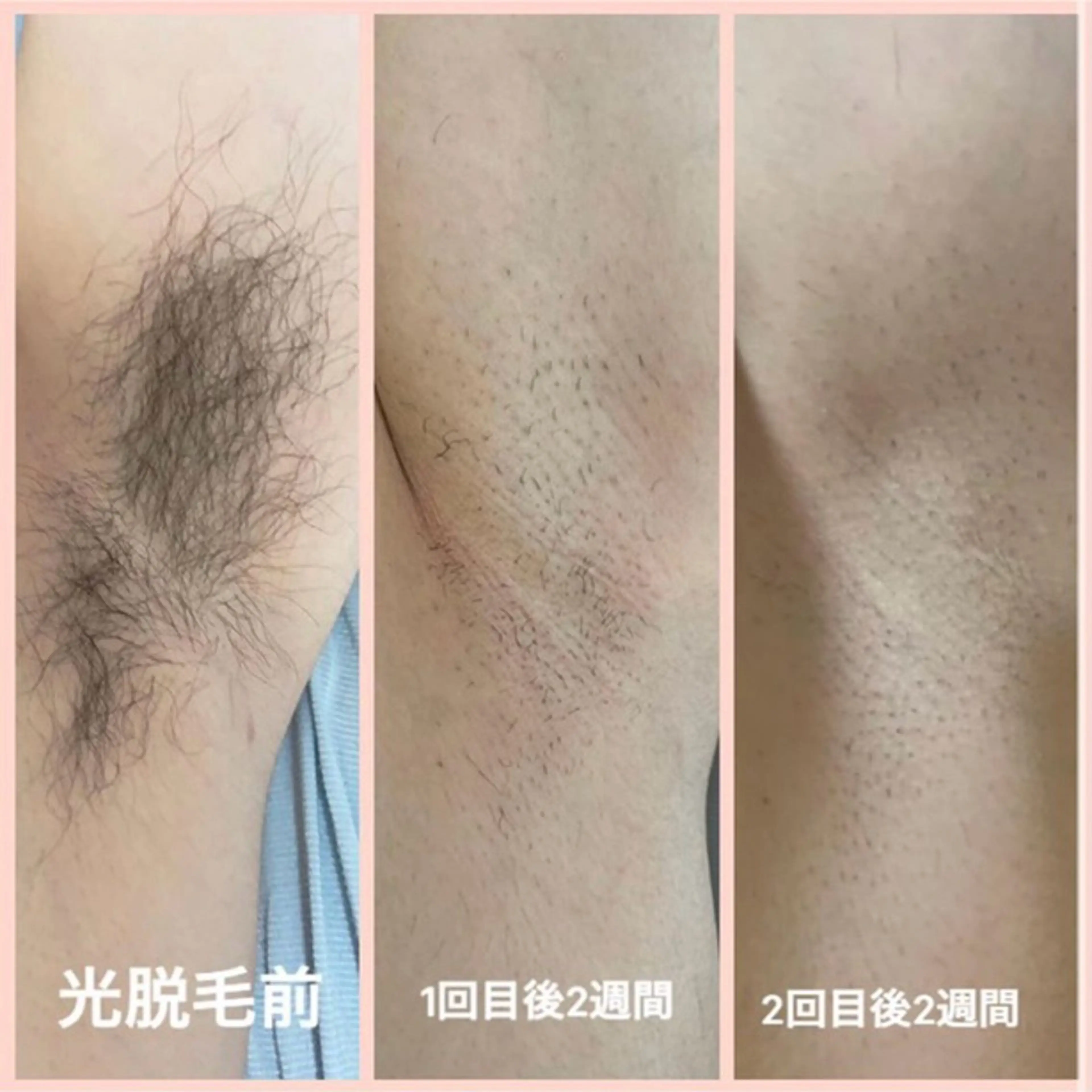 脱毛 crescent所属・【韓国肌管理・脱毛】 クレセントのエステ・リラクイメージ