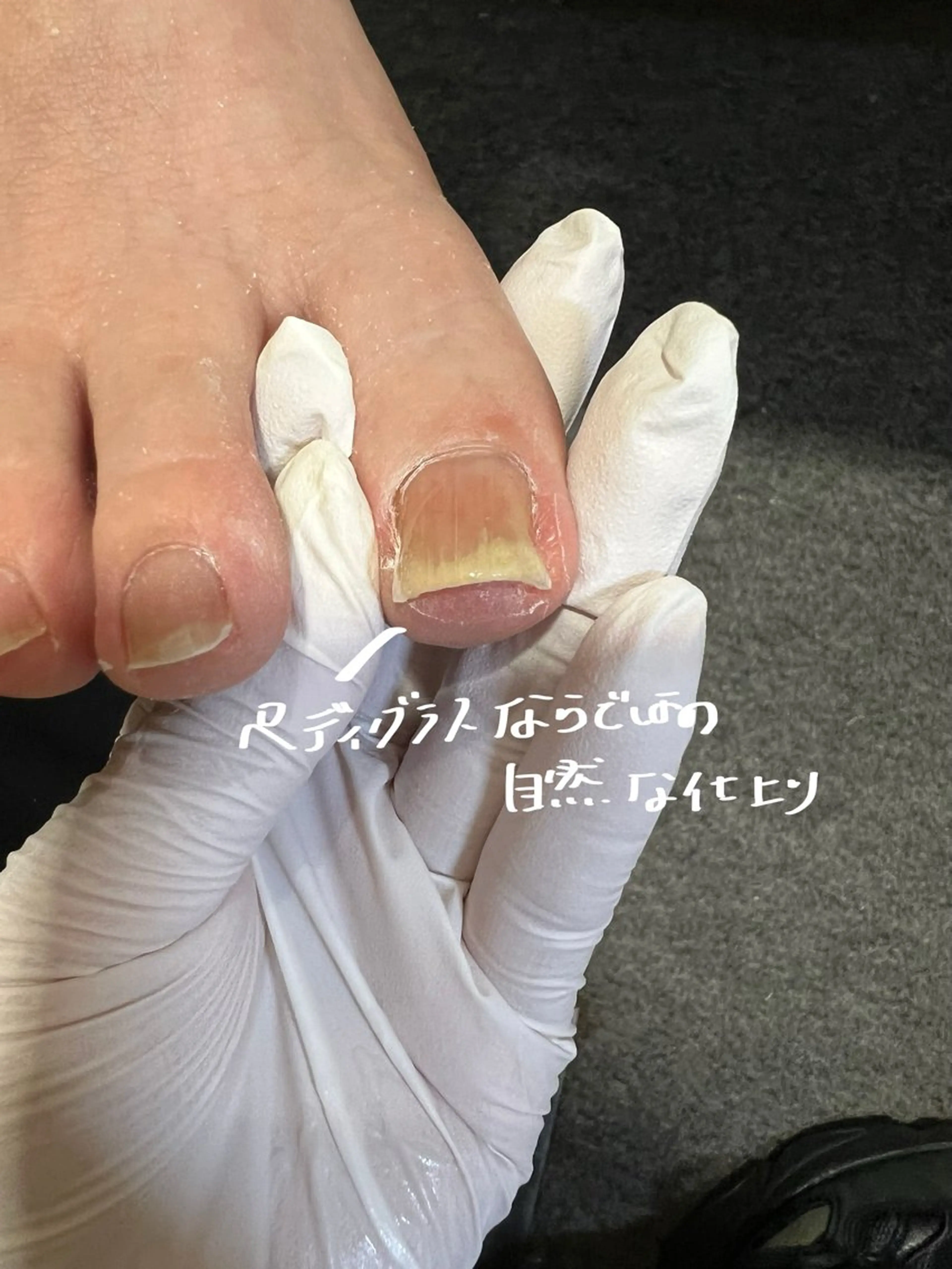 ネイル その他 巻き爪補正店 堺東店のその他イメージ