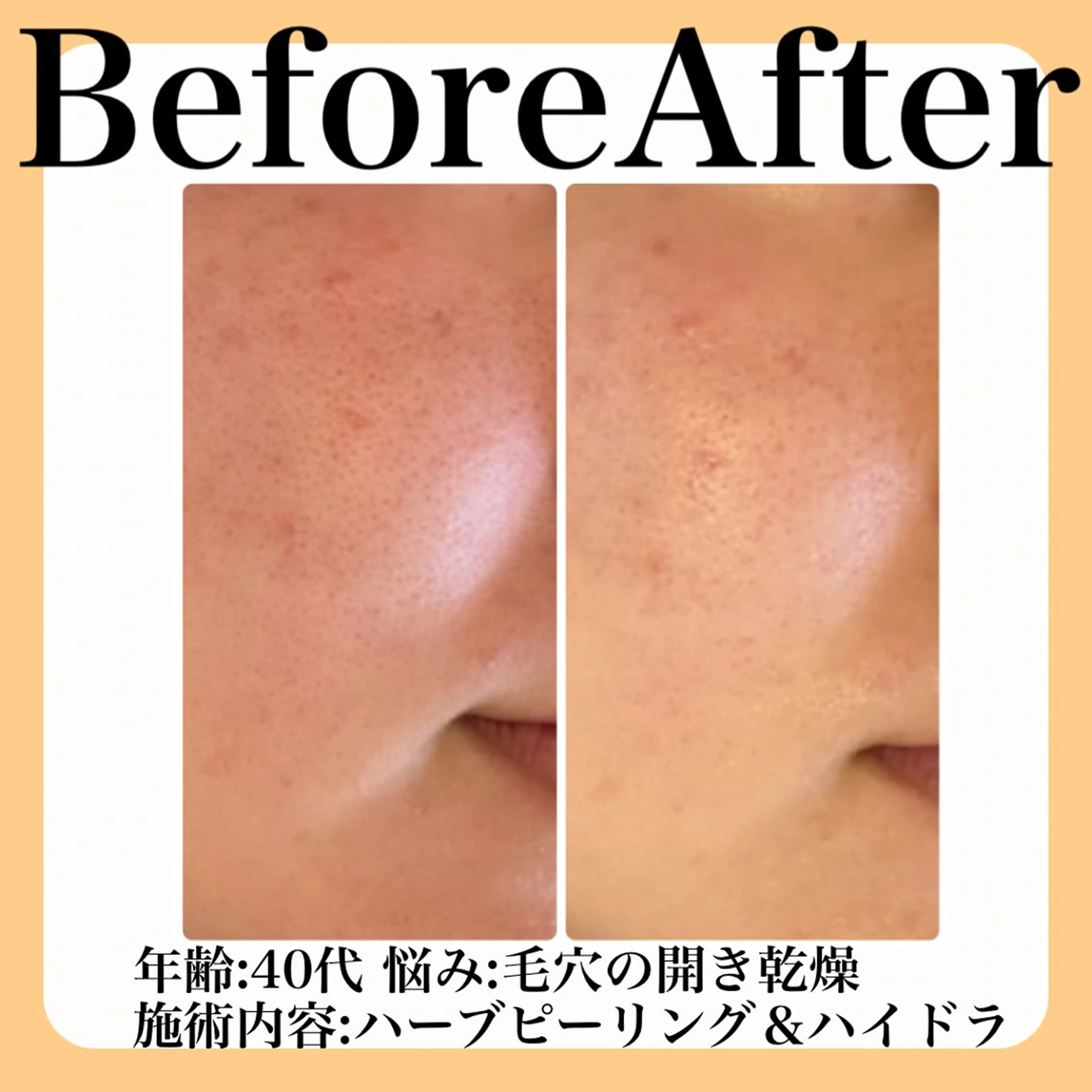 エステ 毛穴・たるみ･ニキビケア専門サロンsui所属・sui【スイ】 ARISAのエステ・リラクイメージ