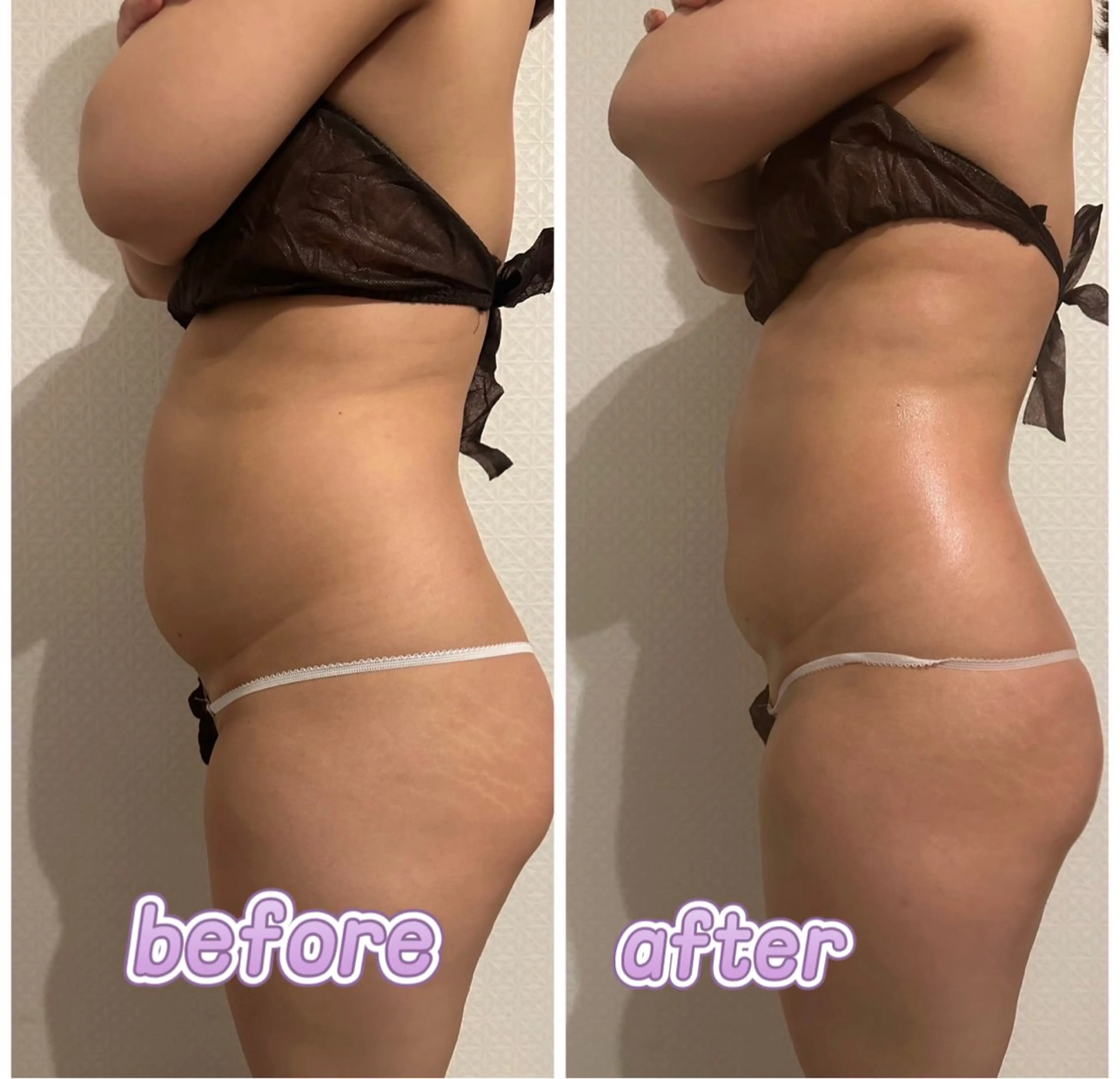 『破格』キャビで気になる2箇所(20分)+全身エステ🌹(60分)頭から爪先まで滞りを流し、キャビで脂肪細胞を解消‼️の写真