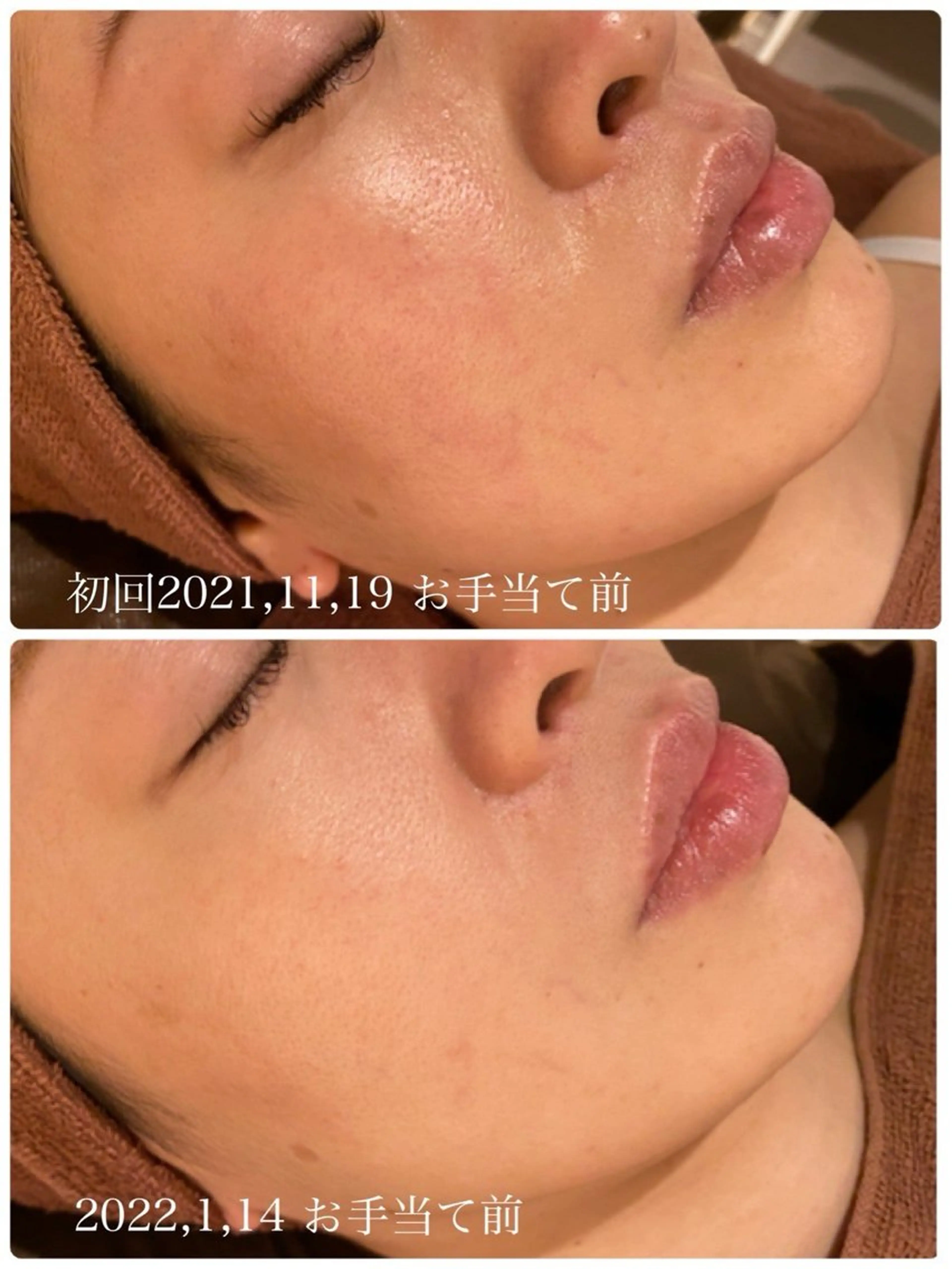 学生ニキビ改善🍀 優しい肌質改善のエステ・リラクイメージ