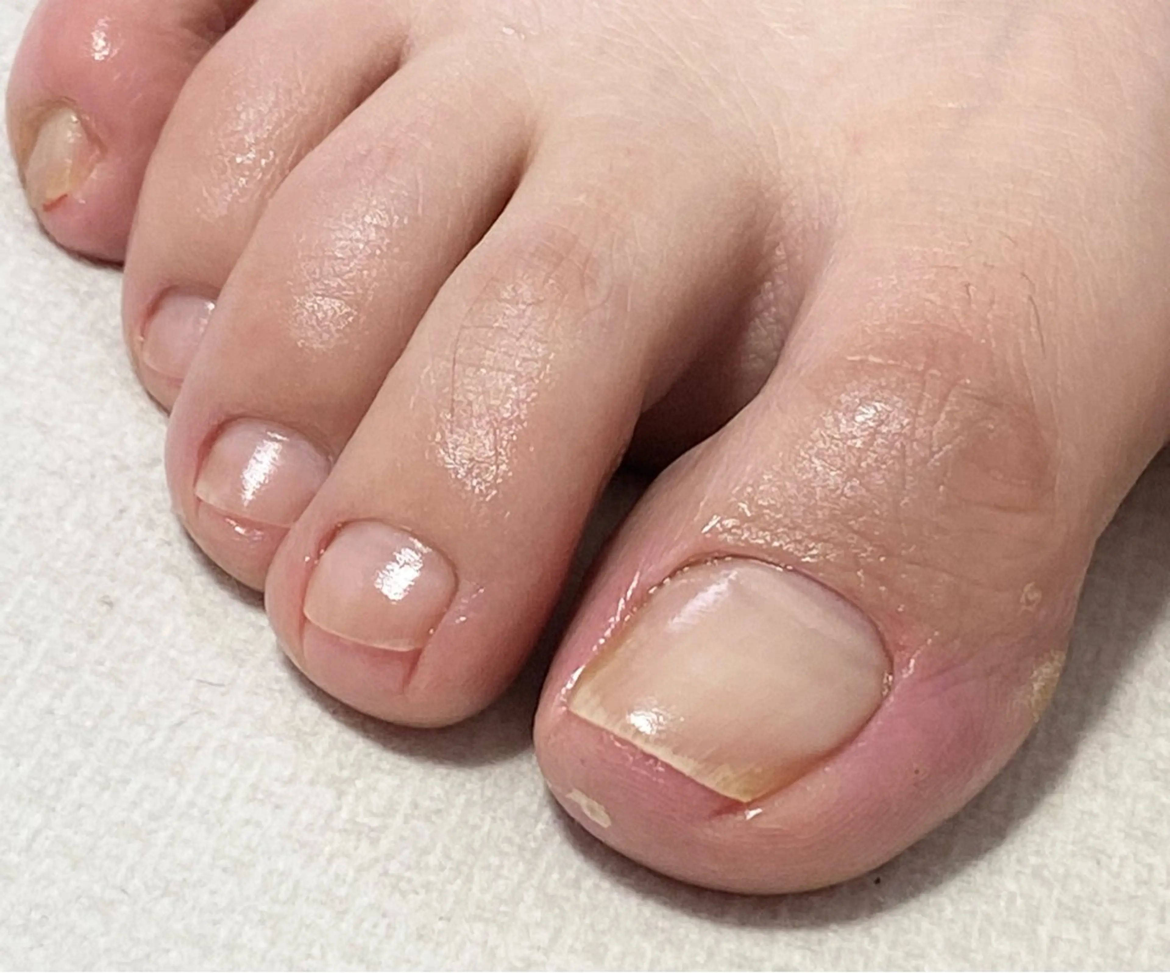 足の指先ケアの写真