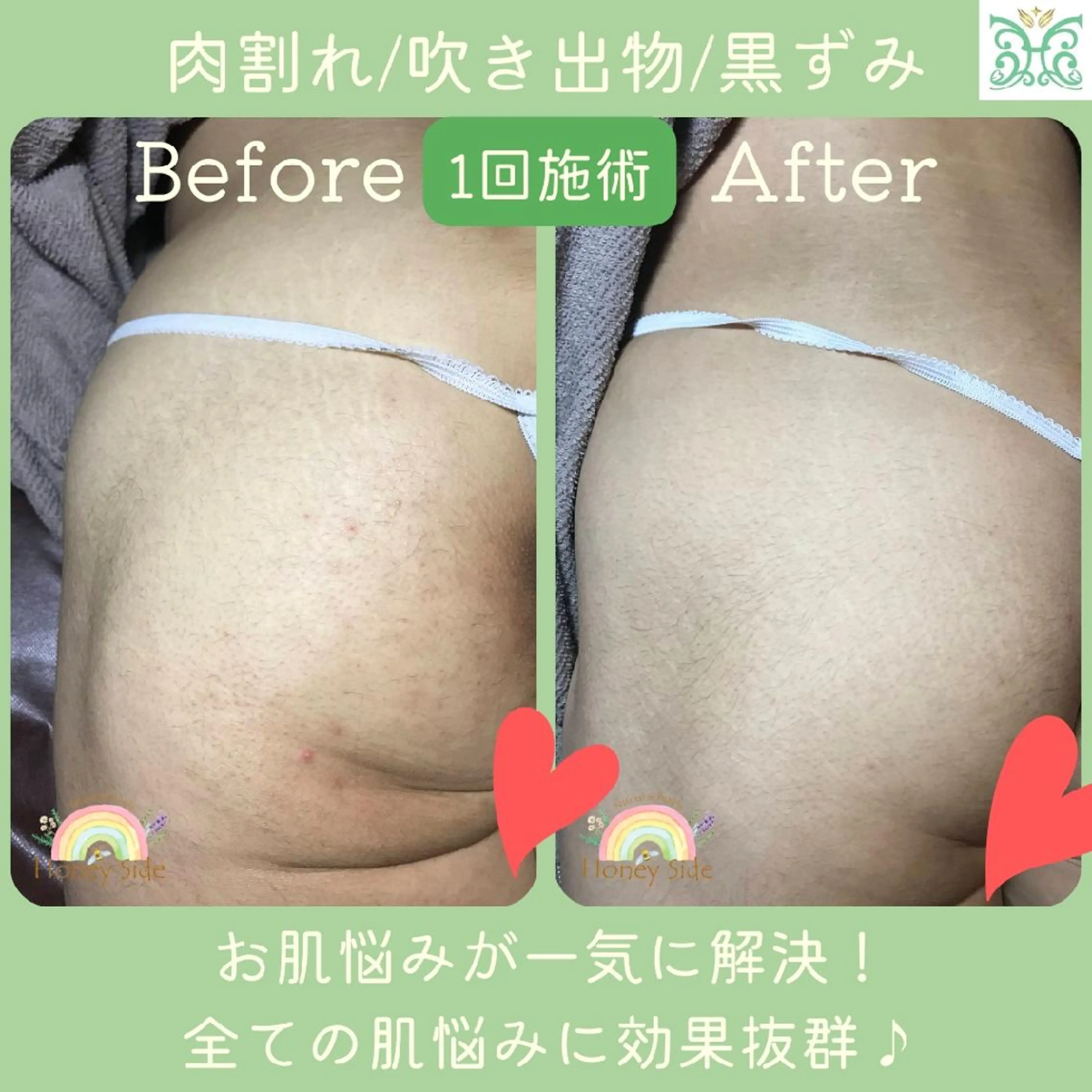エステ 剥離するハーブ🌈 Honey Sideのエステ・リラクイメージ