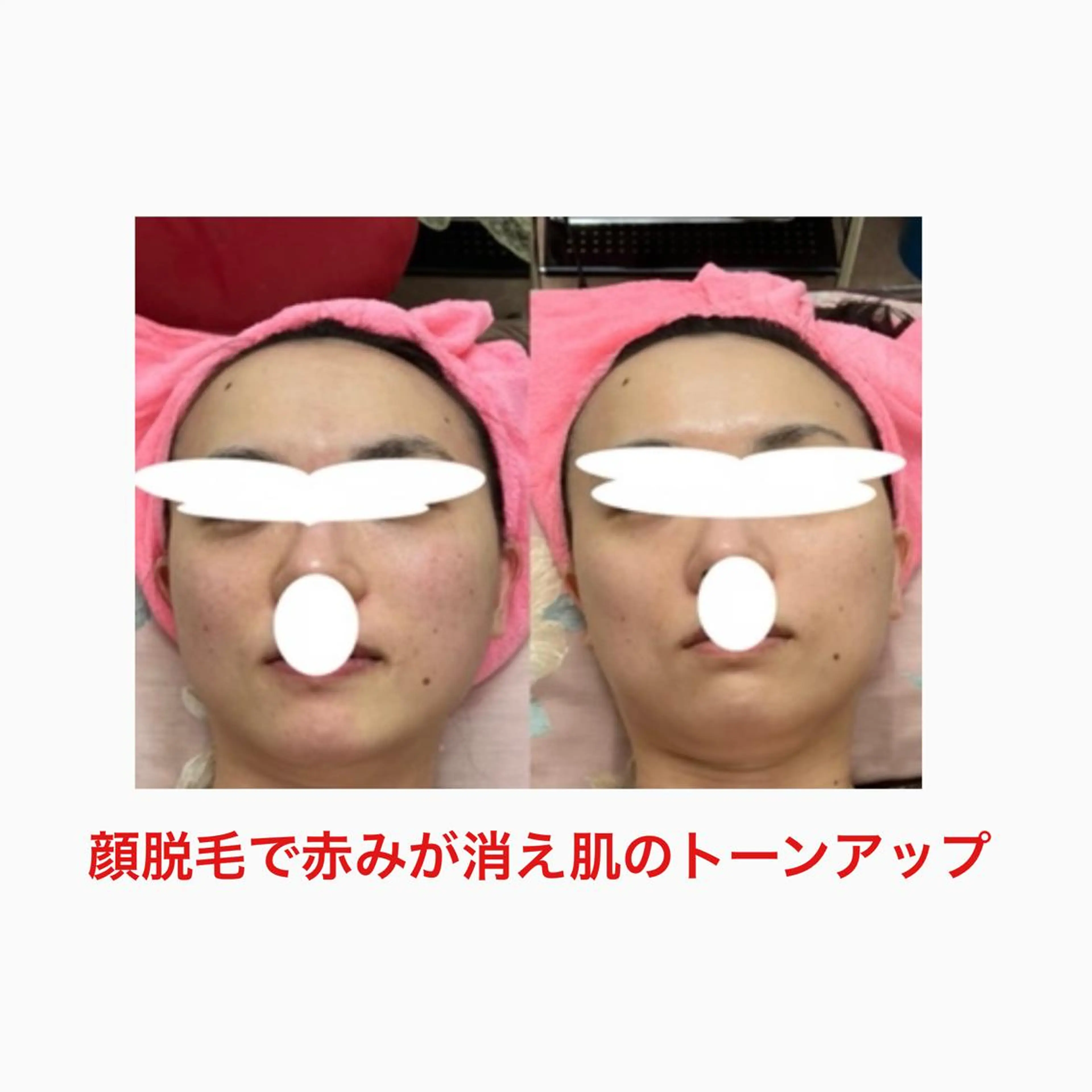 オアシス・さくら所属・中村貴子都度払い脱毛 小顔コルギのエステ・リラクイメージ