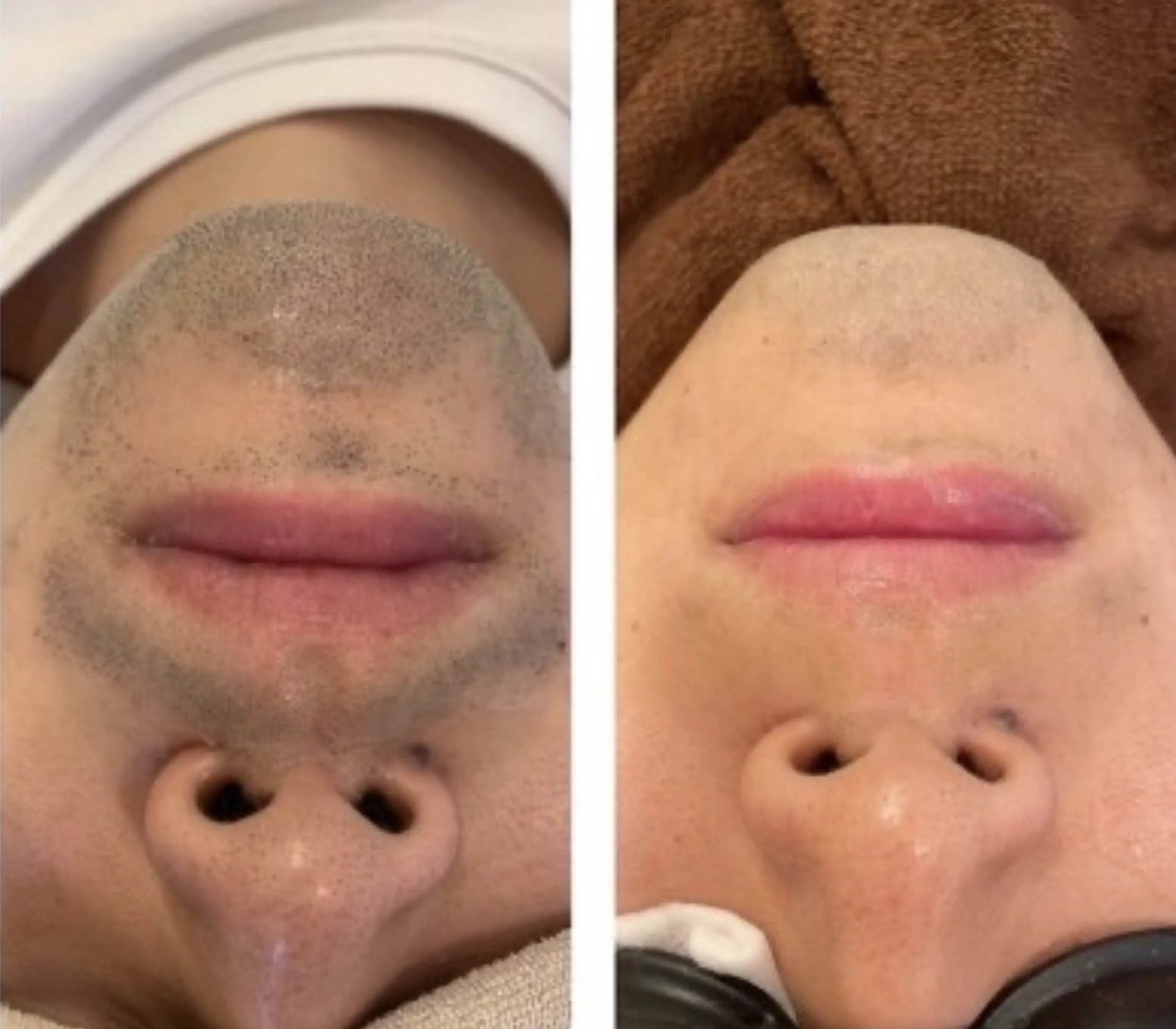 【メンズ脱毛人気No1 】ひげ美肌脱毛¥3980折り返し連絡後確定キャッシュレス決済のみの写真