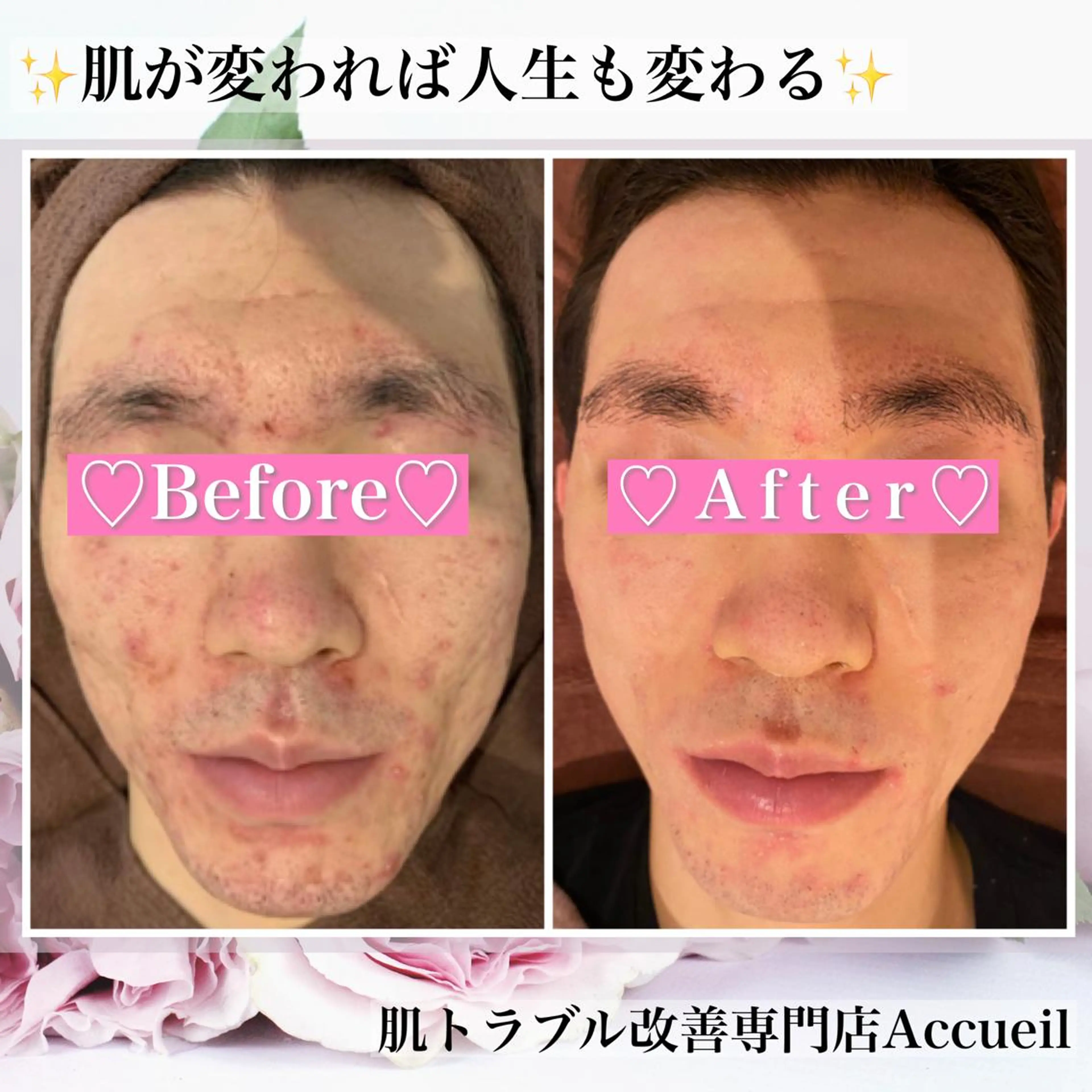 ミディアム カラー パーマ ヘアアレンジ メンズ キッズ ネイル マツエク・マツパ アイブロウ エステ リラク アクール　齋藤 ♡肌トラブル卒業のエステ・リラクイメージ