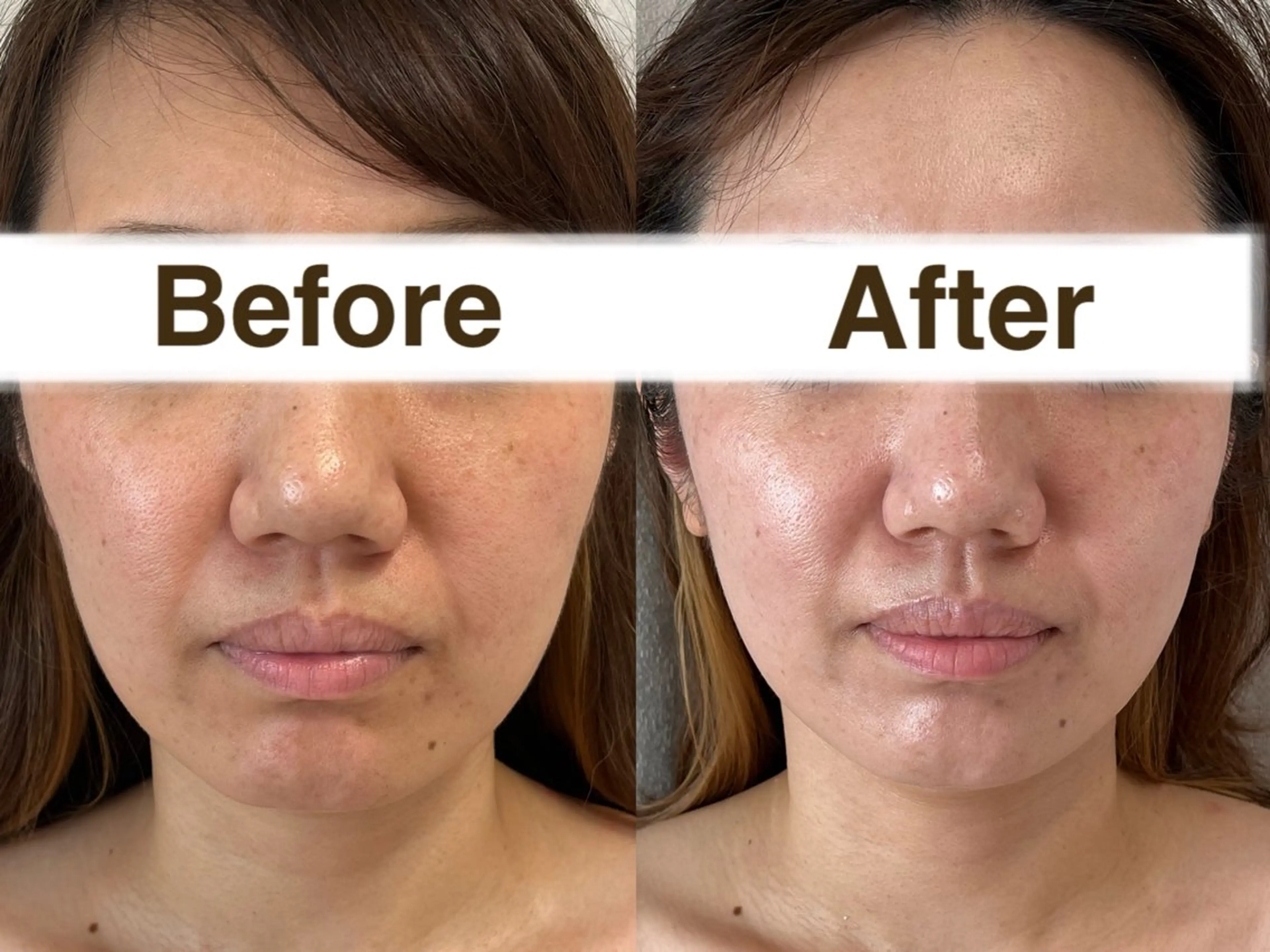 【小顔60分コース】一目でわかる！ヘッド＋フェイシャルで速攻小顔！エラハリ、アゴツン、目ぱっちり！キープ持続に期待大❣️の写真