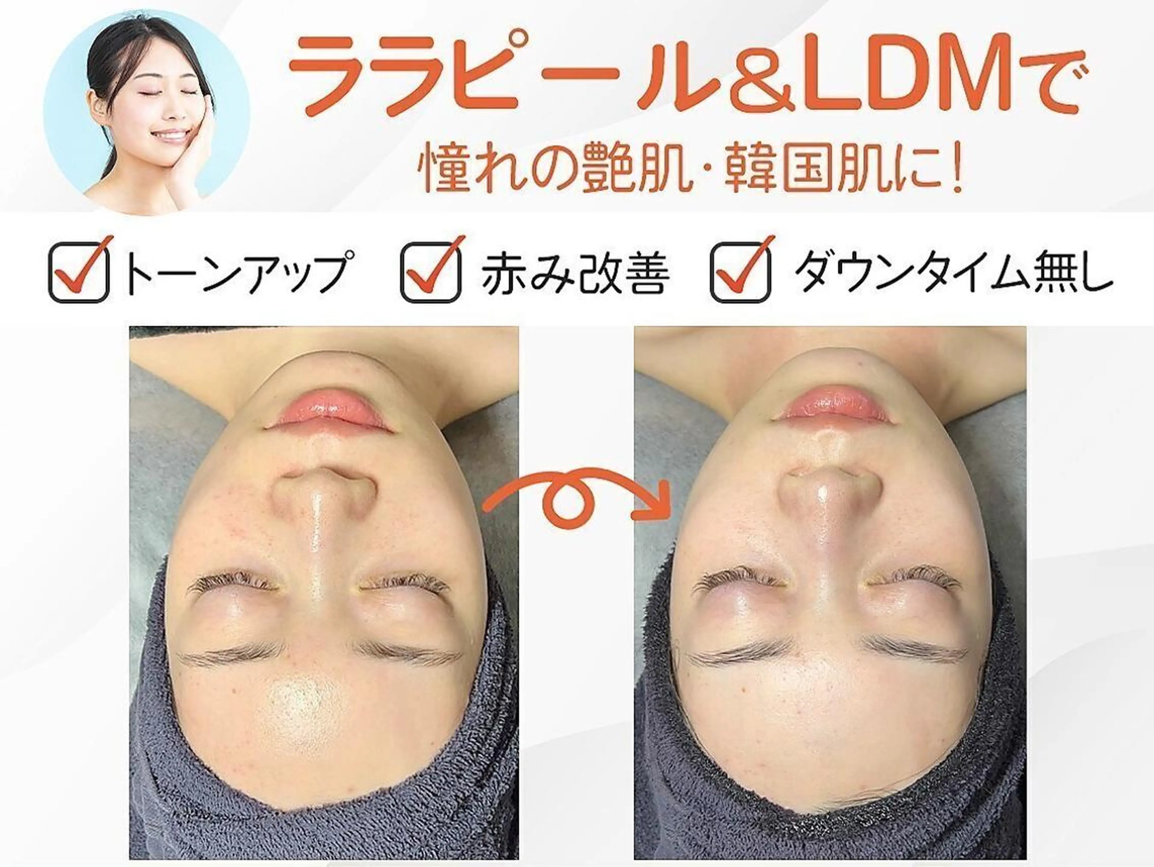 その他 ニキビ・毛穴・肌荒れ ララピール×LDMのその他イメージ