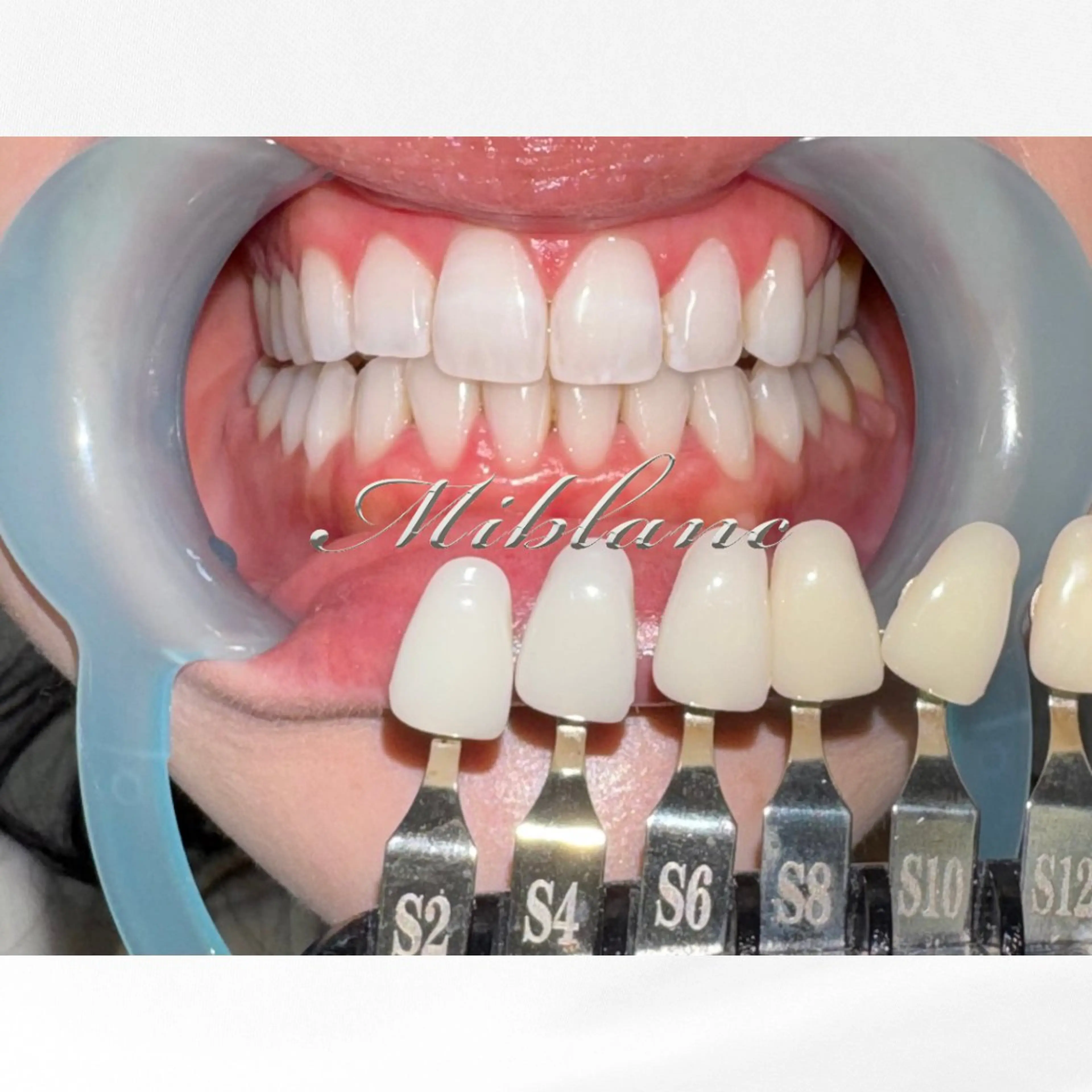 ＼先着5限定／【エリア最大𝟓𝟎分照射💎💠⟡.·】 【白さ効果★★★★★｜白さ効果最大】ホワイトニング50分照射の写真