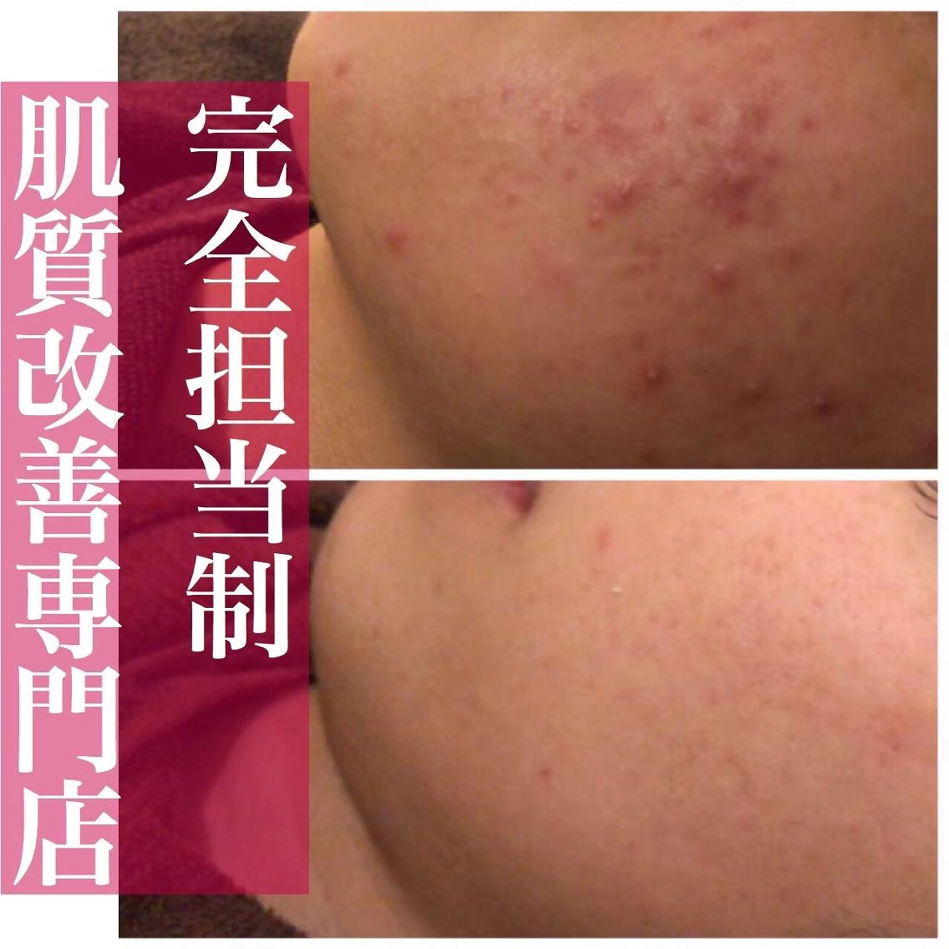 皮膚科より効果あり ⁉️最短ニキビ改善のエステ・リラクイメージ