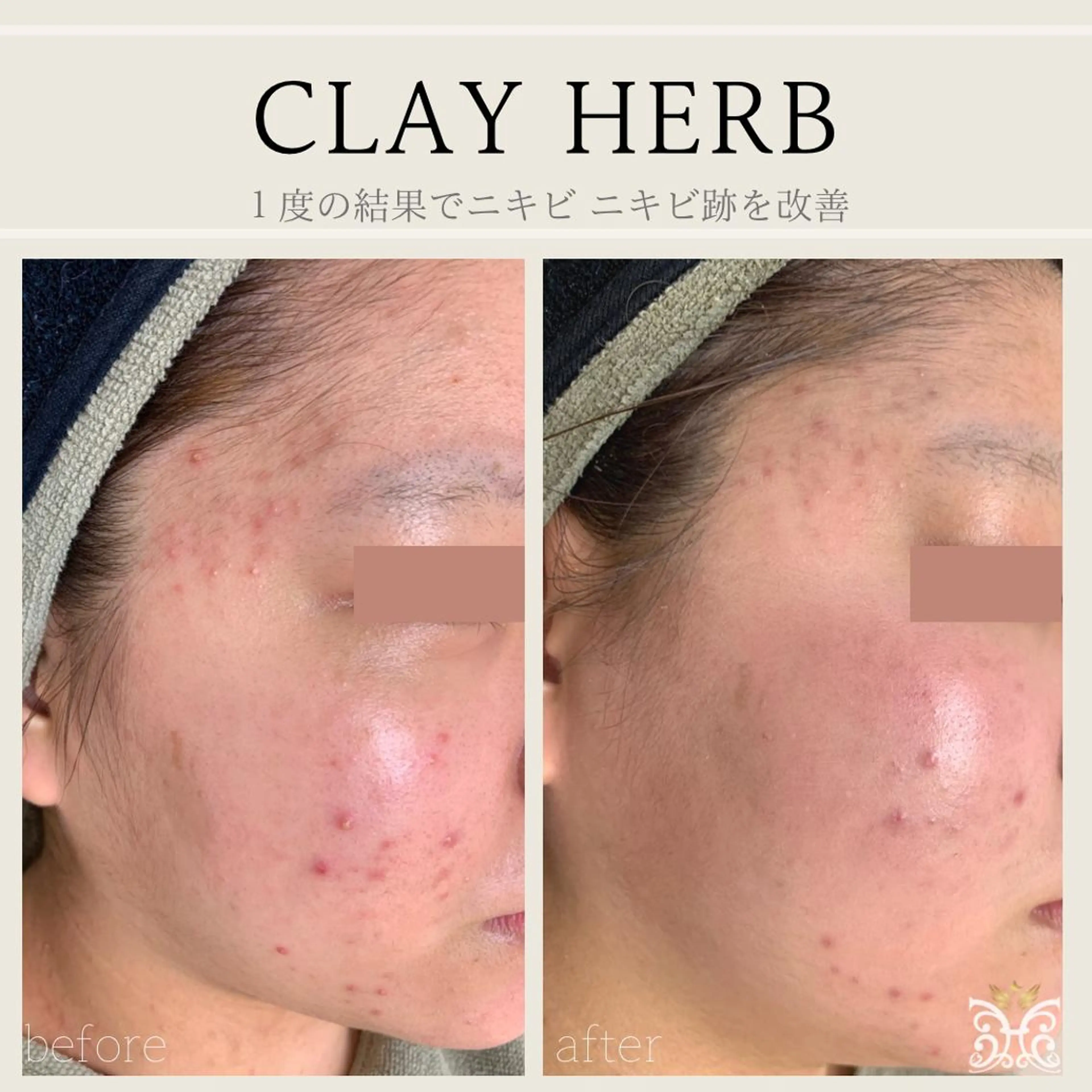 エステ リラク 【剥離ありハーブピーリング専門エステ】cerisier BEAUTÉ 原宿所属・cerisier BEAUTÉのエステ・リラクイメージ