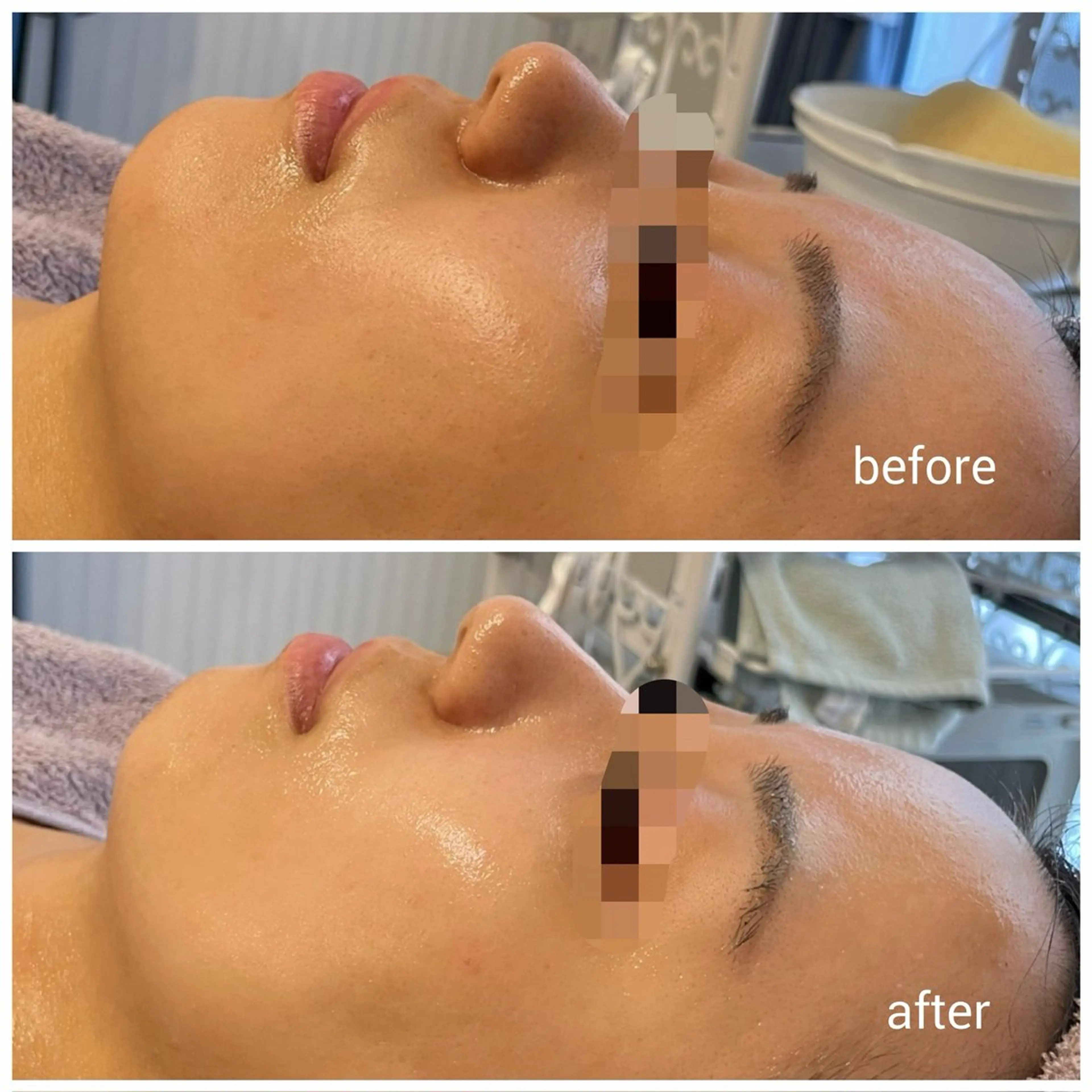 毛穴改善ハーブピーリングMinouミヌ心斎橋所属・ミヌ心斎橋 あやめのエステ・リラクイメージ