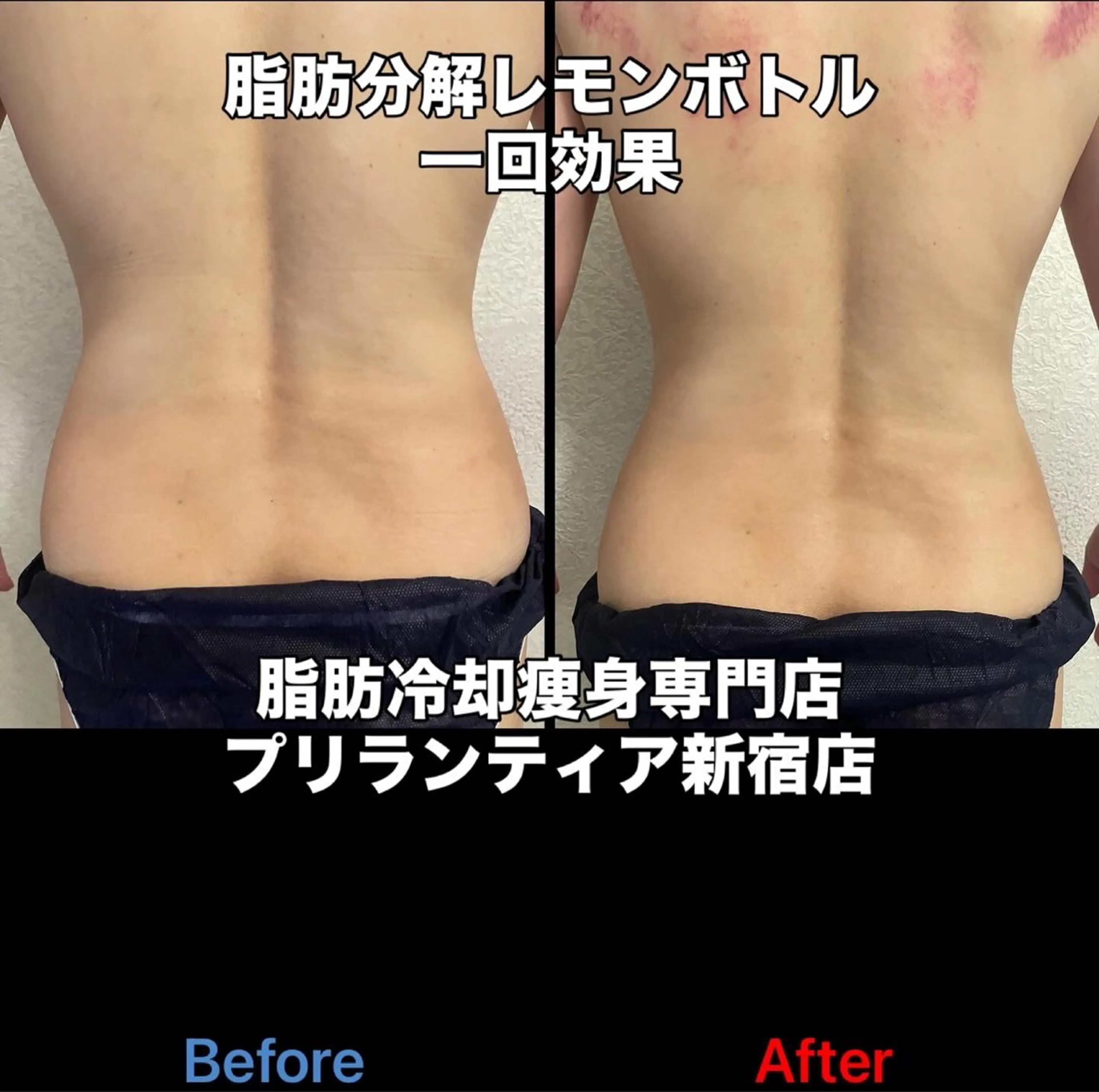 【痩身冷却2箇所&分解レモン✨ボトル/ボディ】すっきりお腹 ¥ 25,800の写真