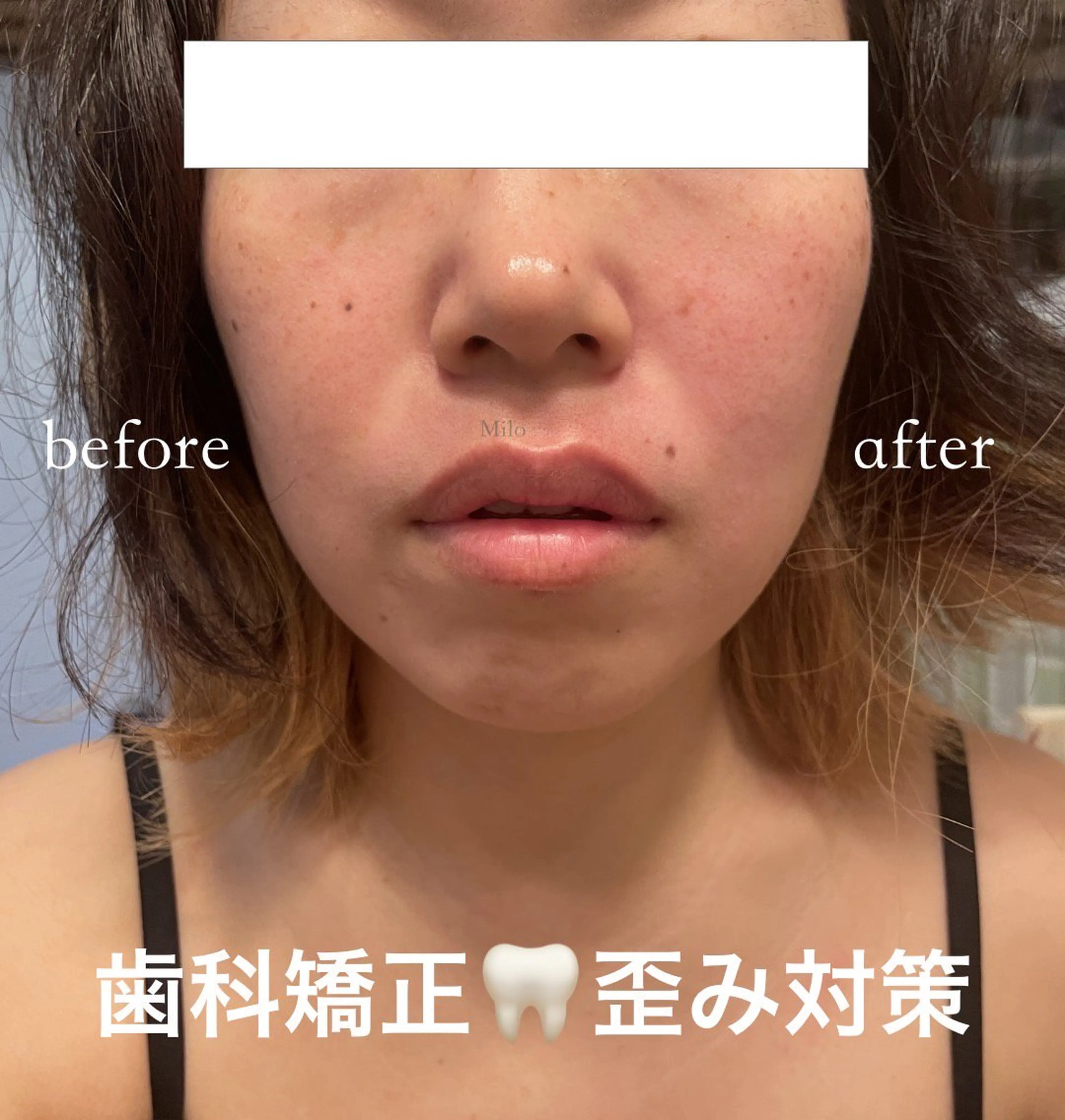 【インビザライン・歯科矯正☆応援プラン📣】🦷歯科矯正による独特のお顔の歪みや頭痛に!噛み締めライン徹底コース☆45分の写真