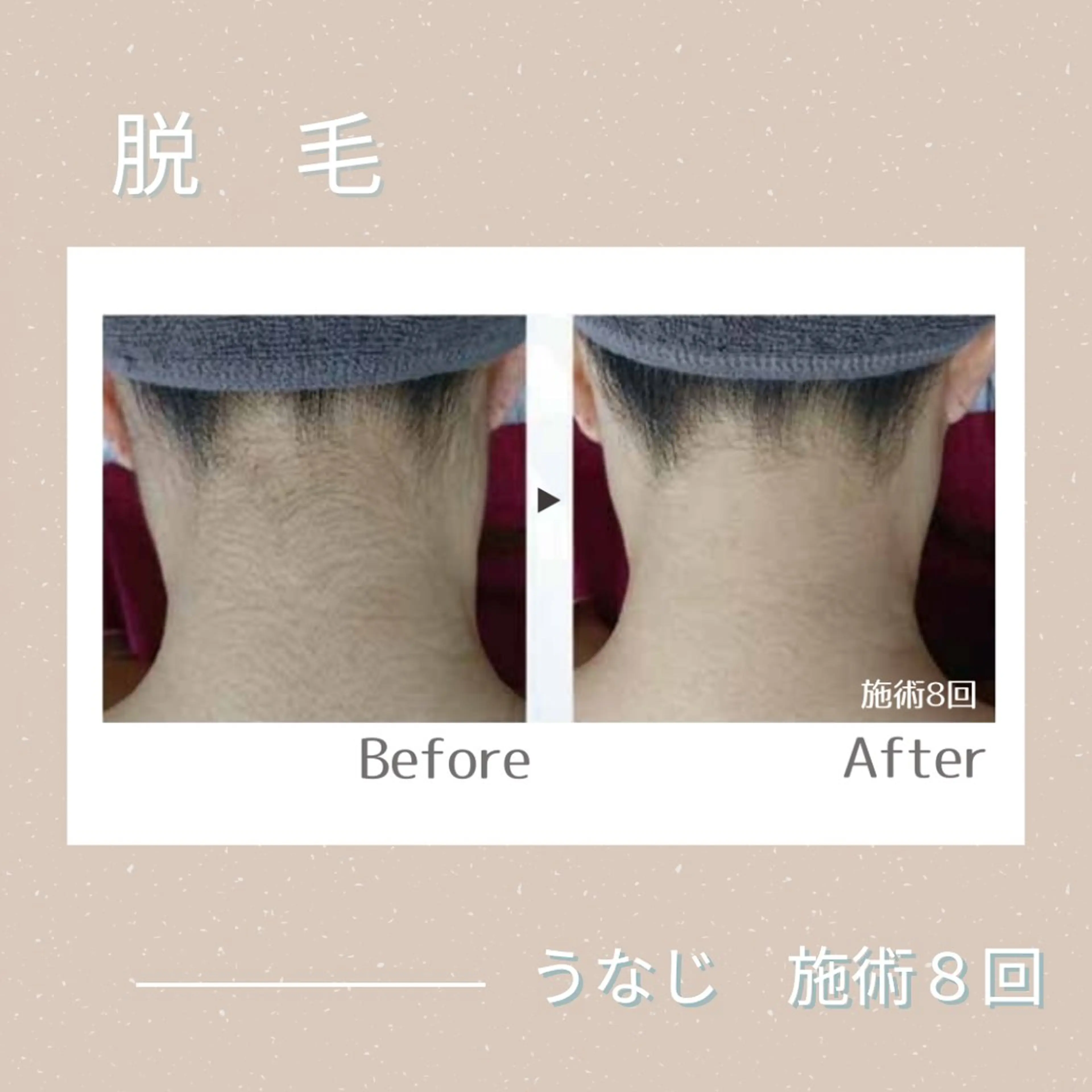うなじ脱毛の写真