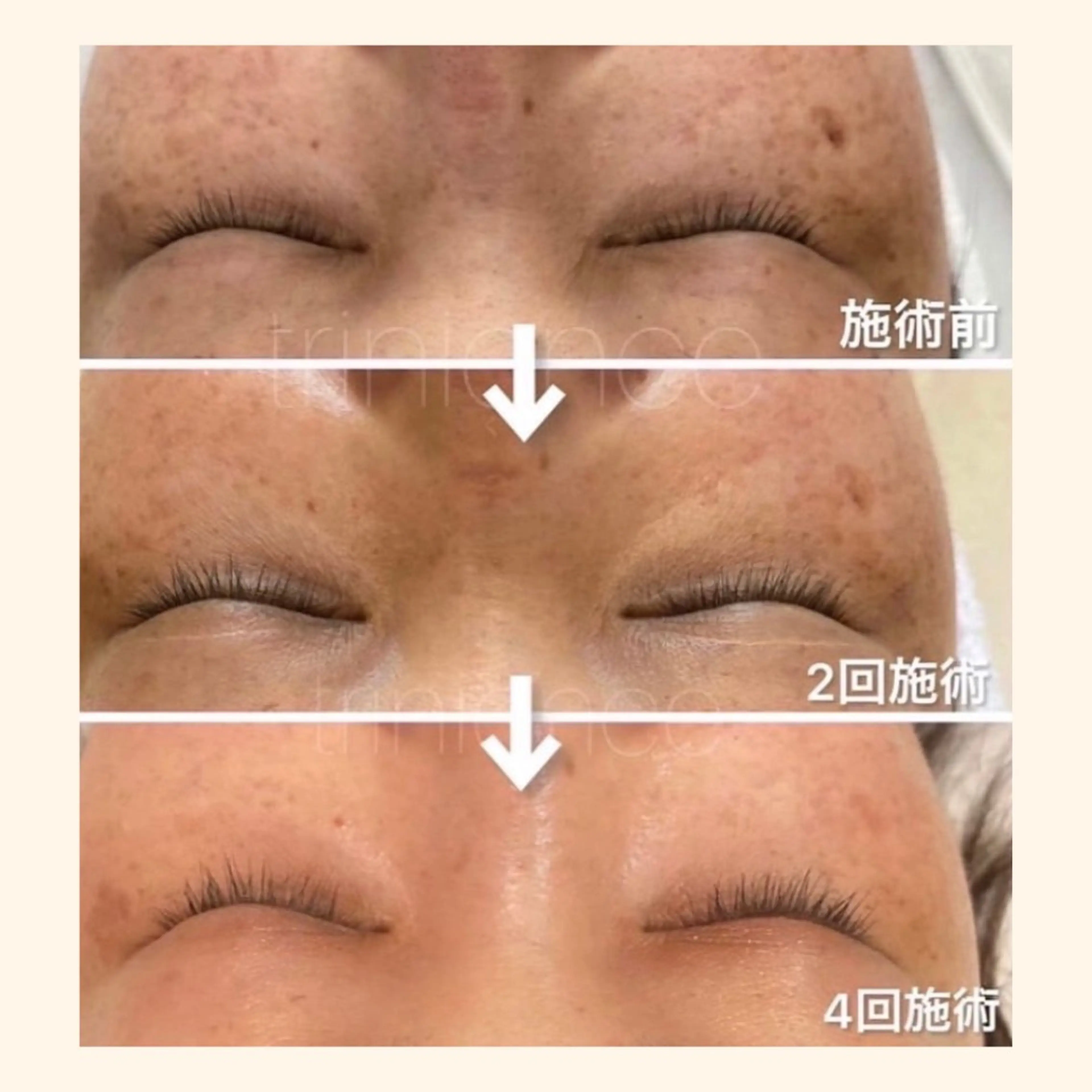 マツエク・マツパ その他 韓国肌管理 【毛穴専科】のエステ・リラクイメージ