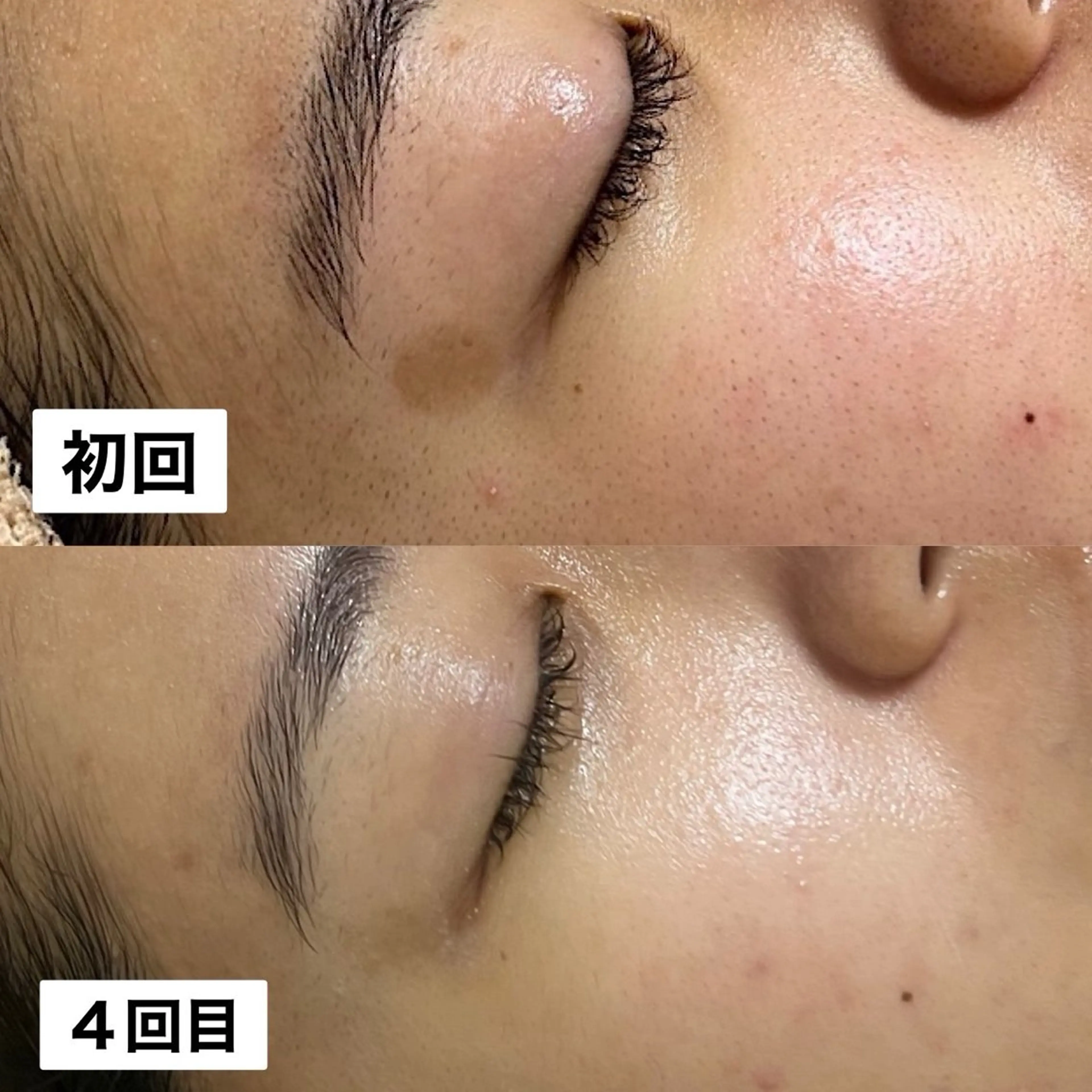 【シミ30分取り放題】最新シミケアマシーン！【練習モデル】の写真