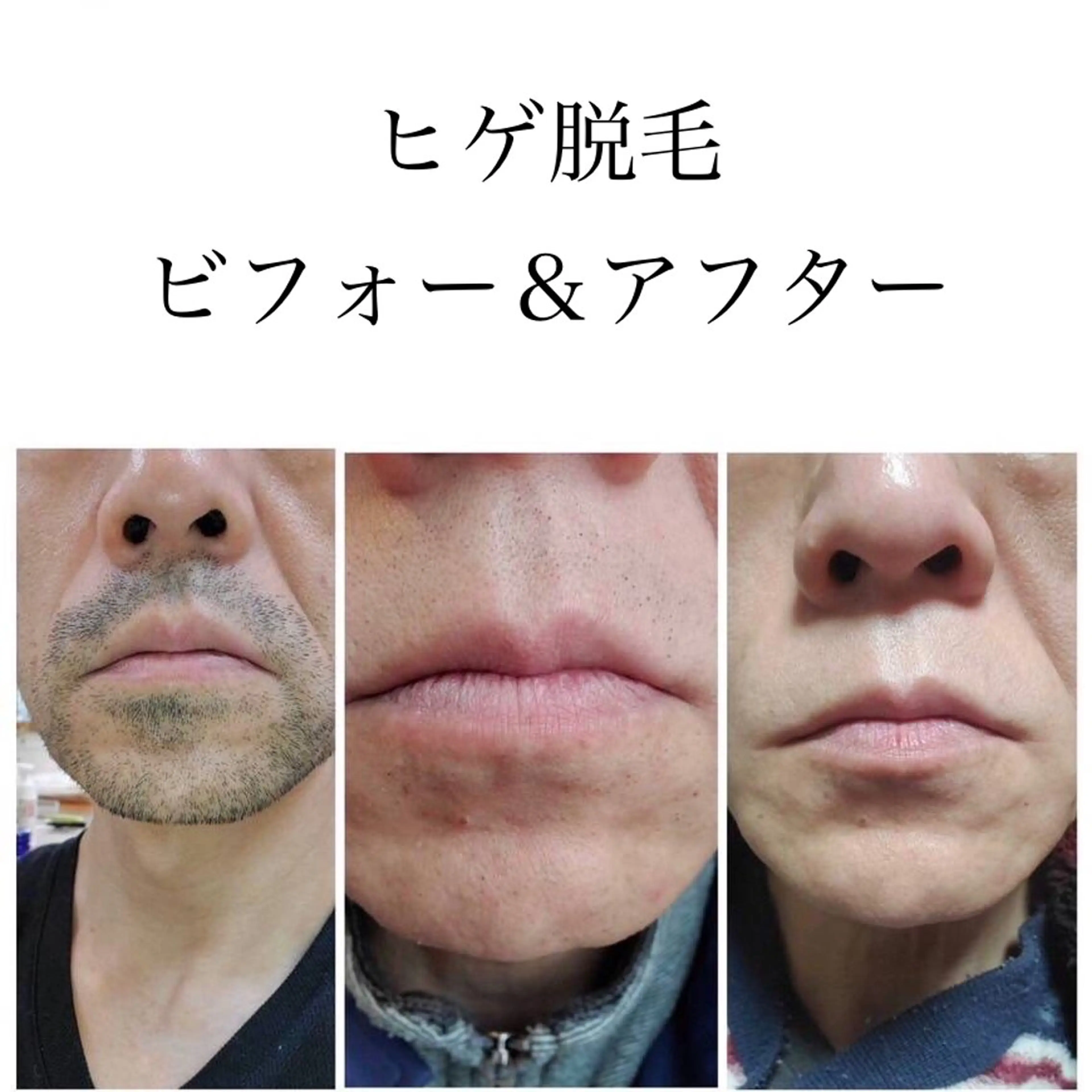 痛くない👨men's脱毛 顔(ヒゲ+眉周り+頬+おでこ+鼻+耳毛)+パック&首リンパ+ヘッドのエステ付💆脱毛&美肌への写真