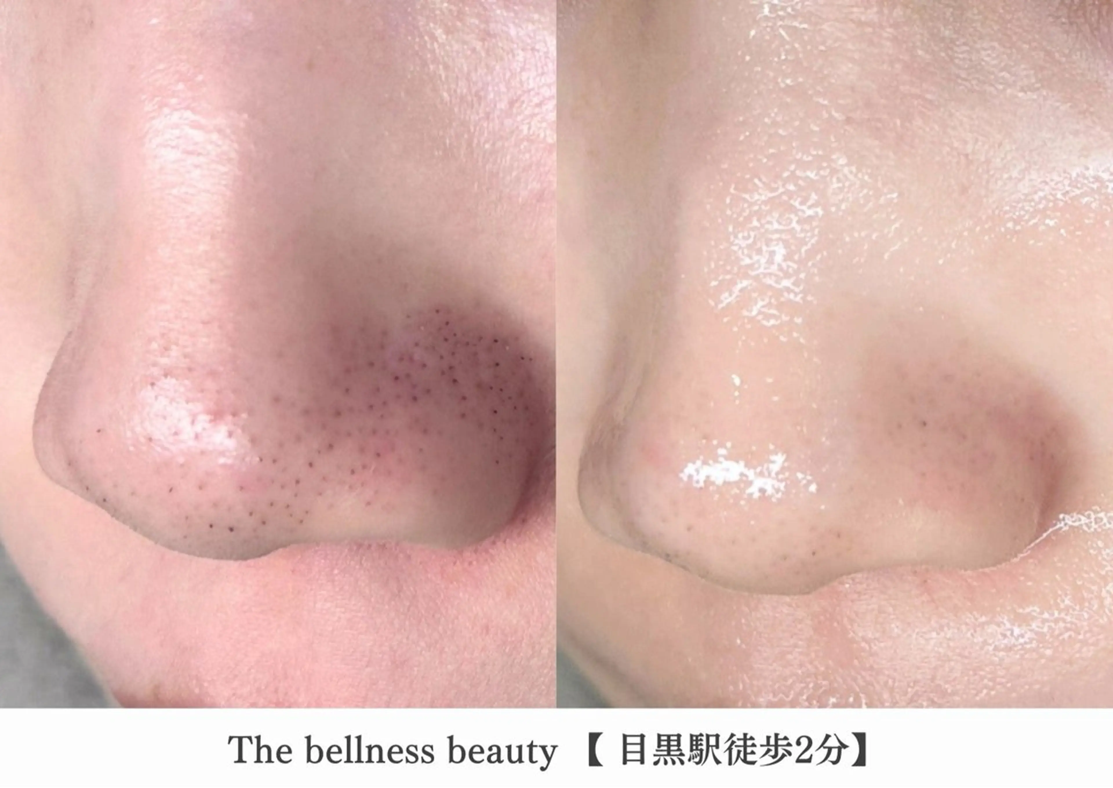 エステ 《毛穴レス美肌》ザ・ ベルネス 目黒駅2分のエステ・リラクイメージ