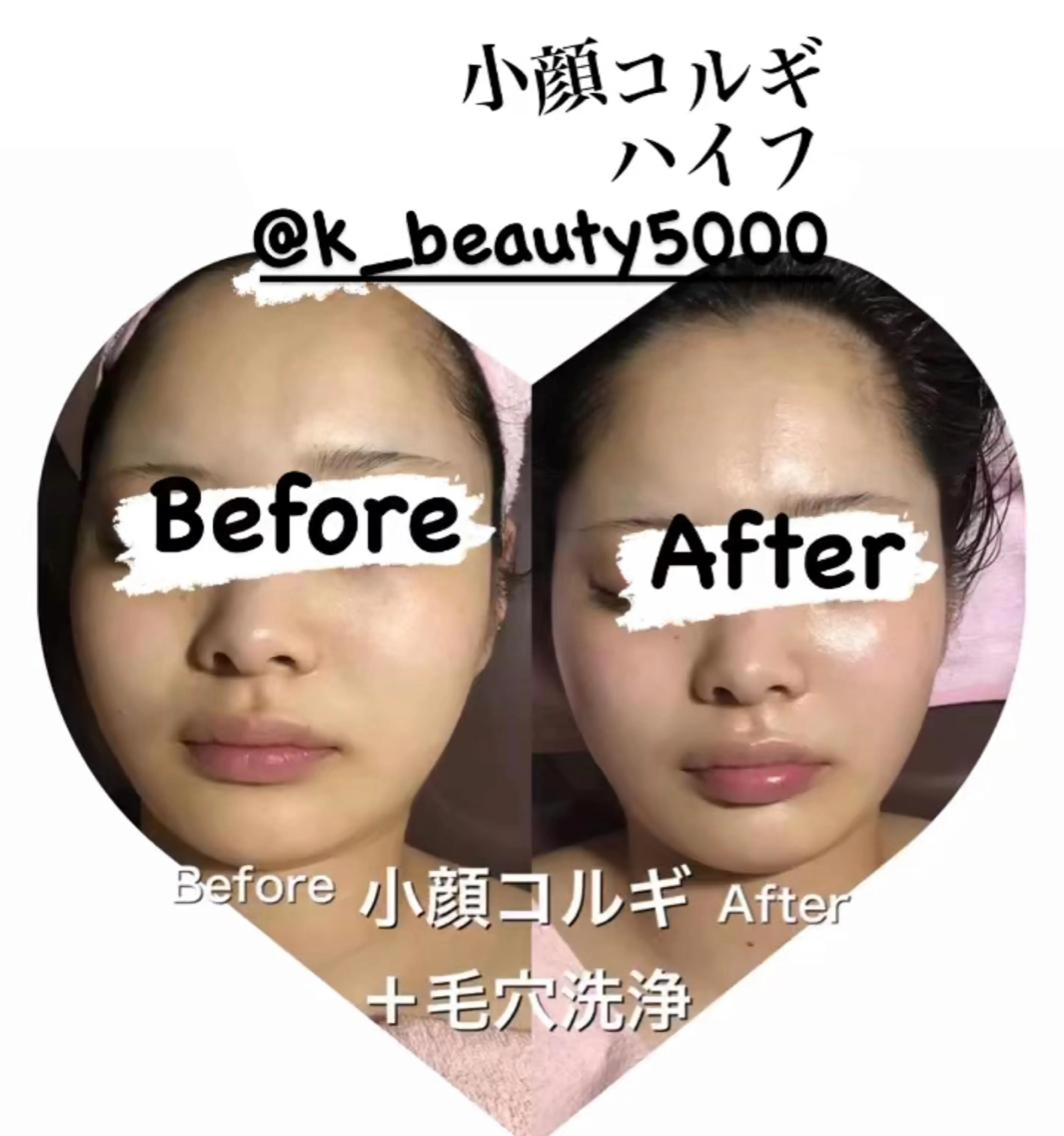 【ハイパーナイフ痩身&小顔コルギ&ハーブピーリング】K-Beauty　東新宿所属・kーbeauty小顔 コルギ&インディバのエステ・リラクイメージ