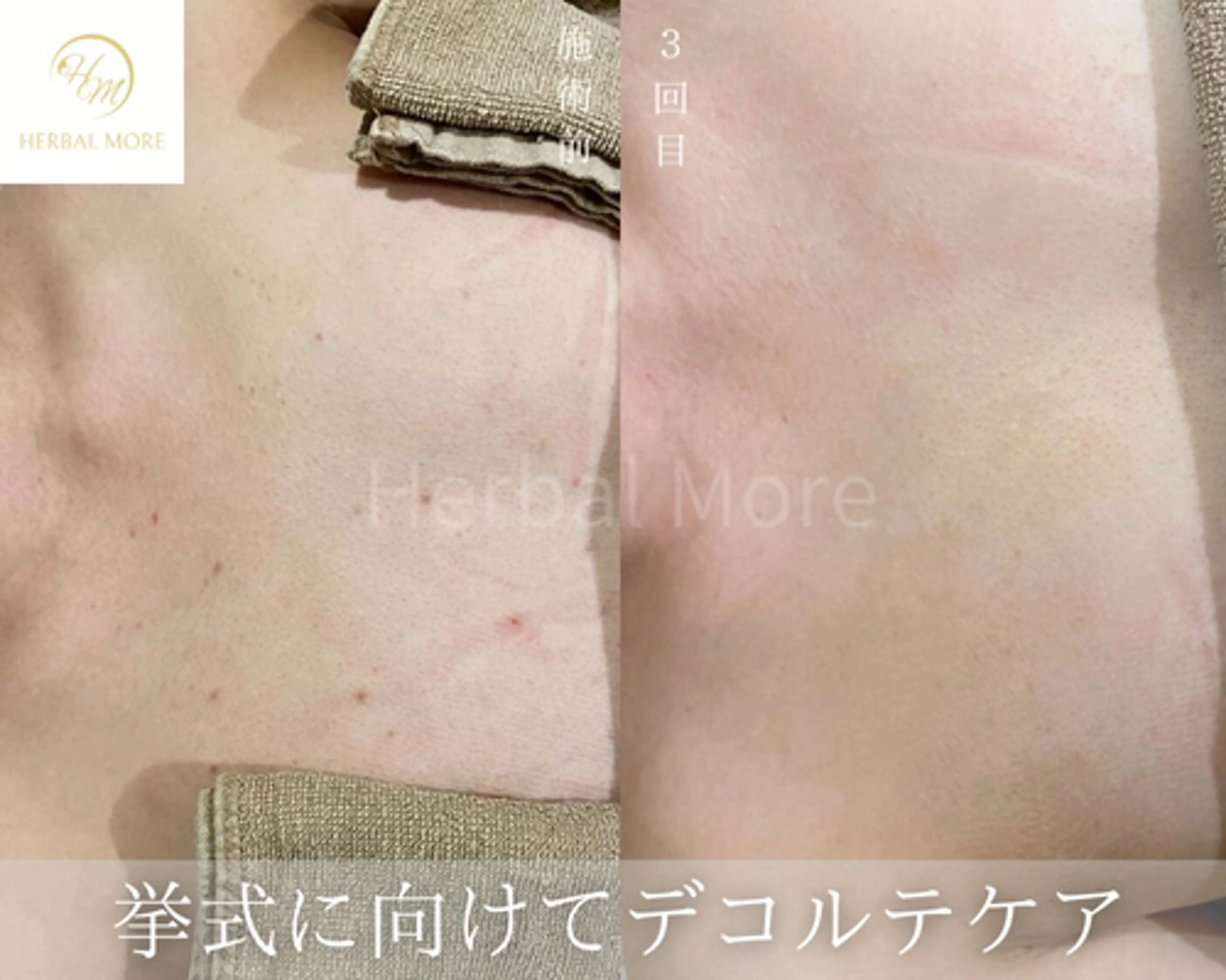 【デコルテのハーブピーリング/剥離有・無】の写真