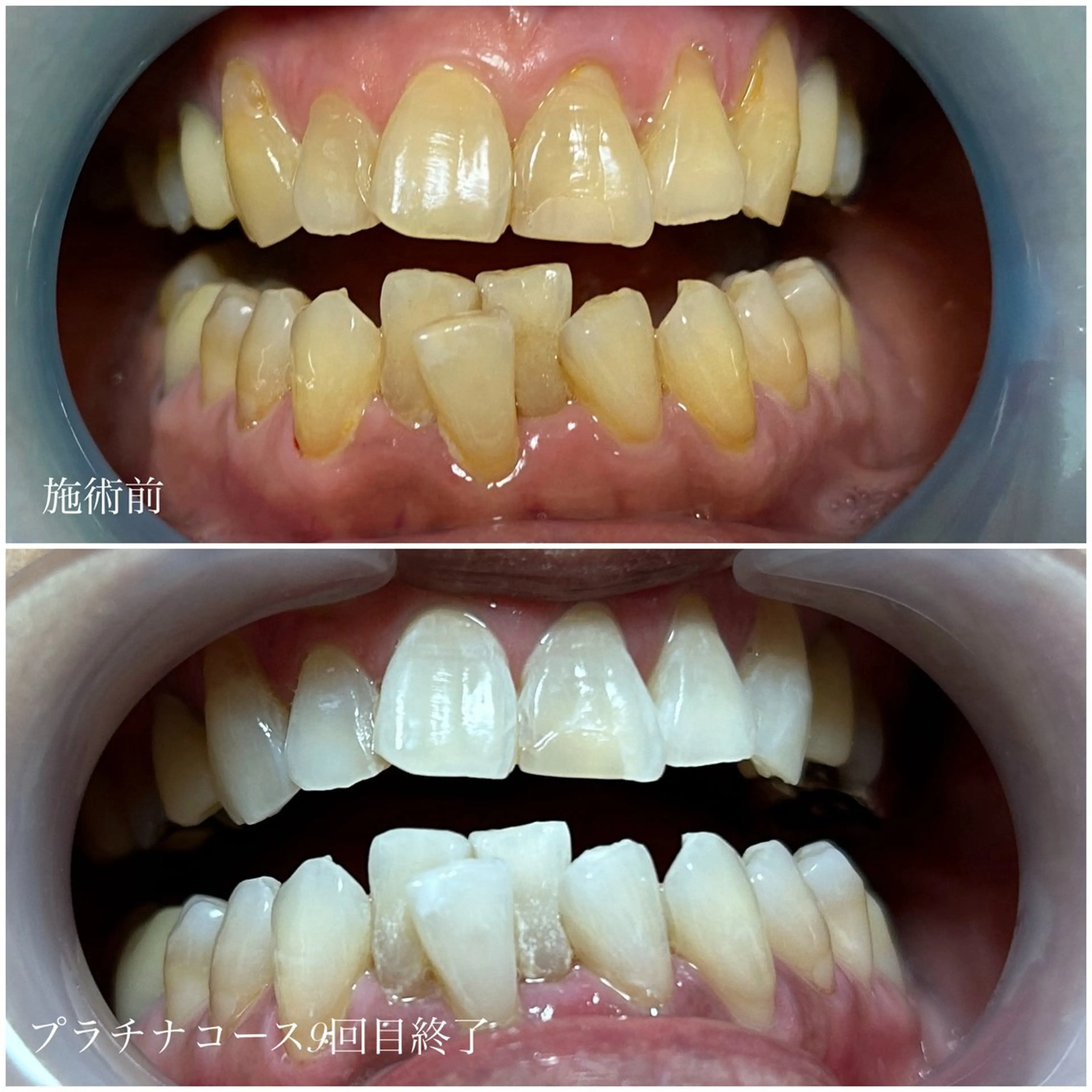 その他 ネイル/耳つぼ /新ホワイトニングのネイルデザイン