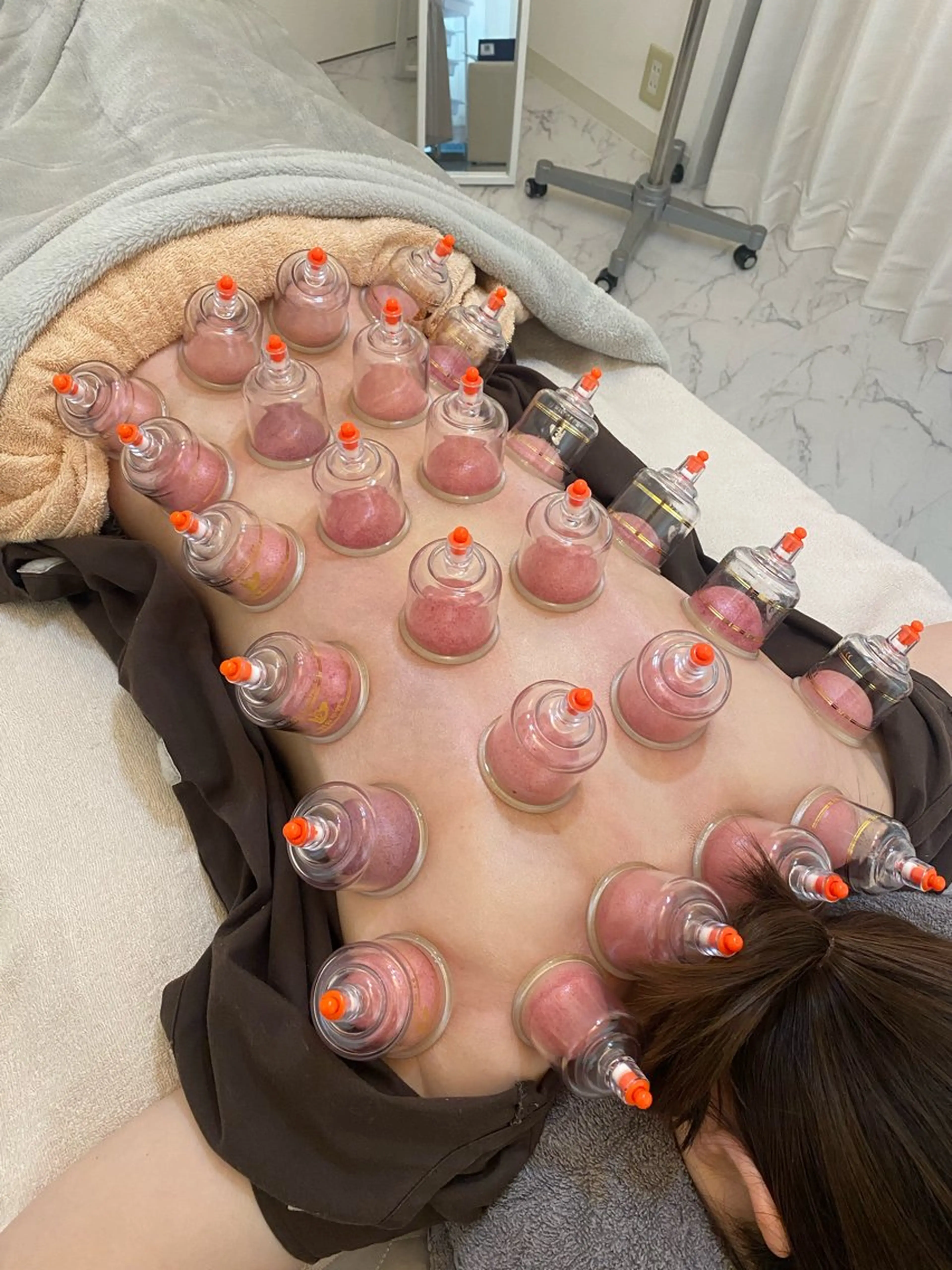 首肩こり＋吸玉の写真