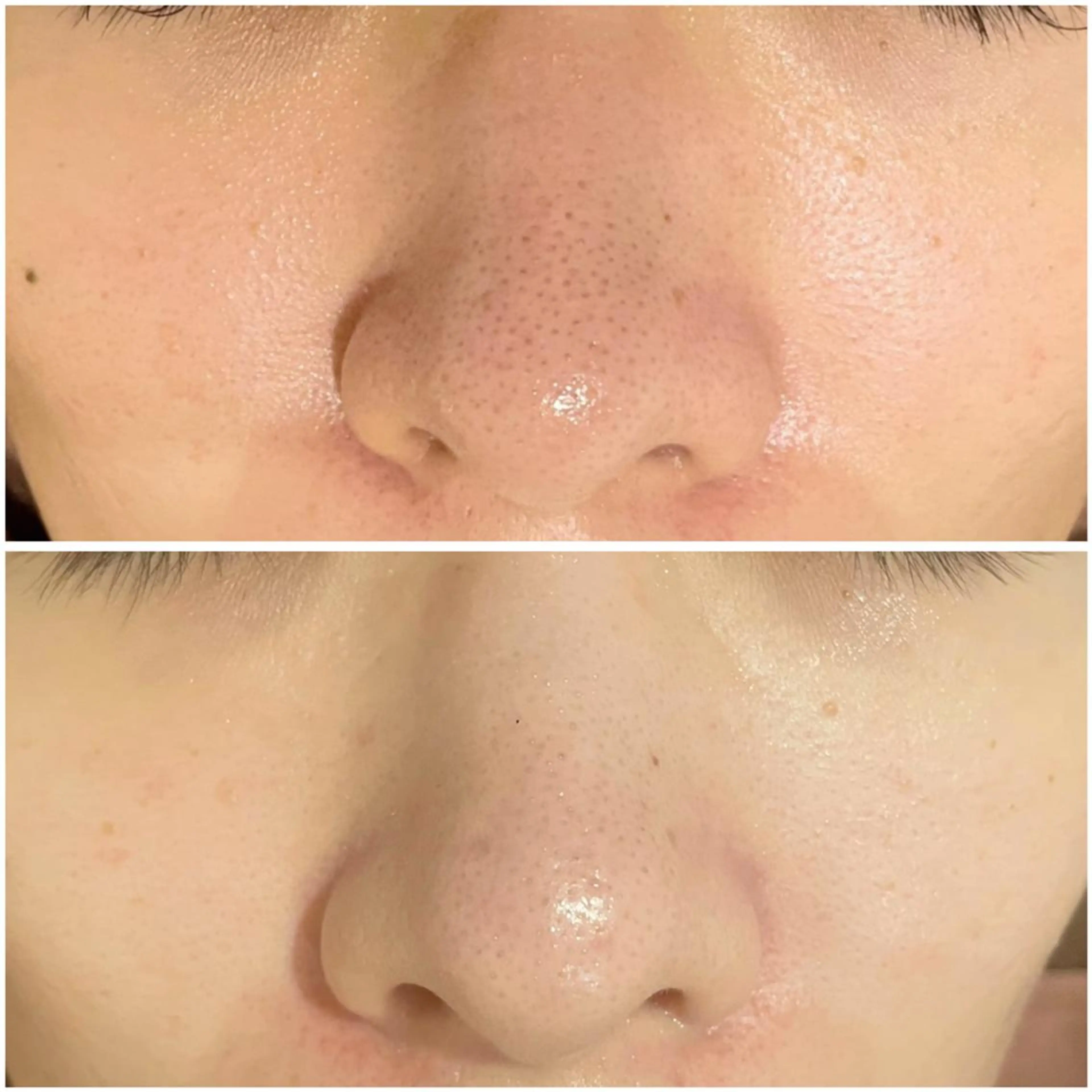 エステ リラク ニキビ跡改善専門🔥 医療にはできない改善のエステ・リラクイメージ