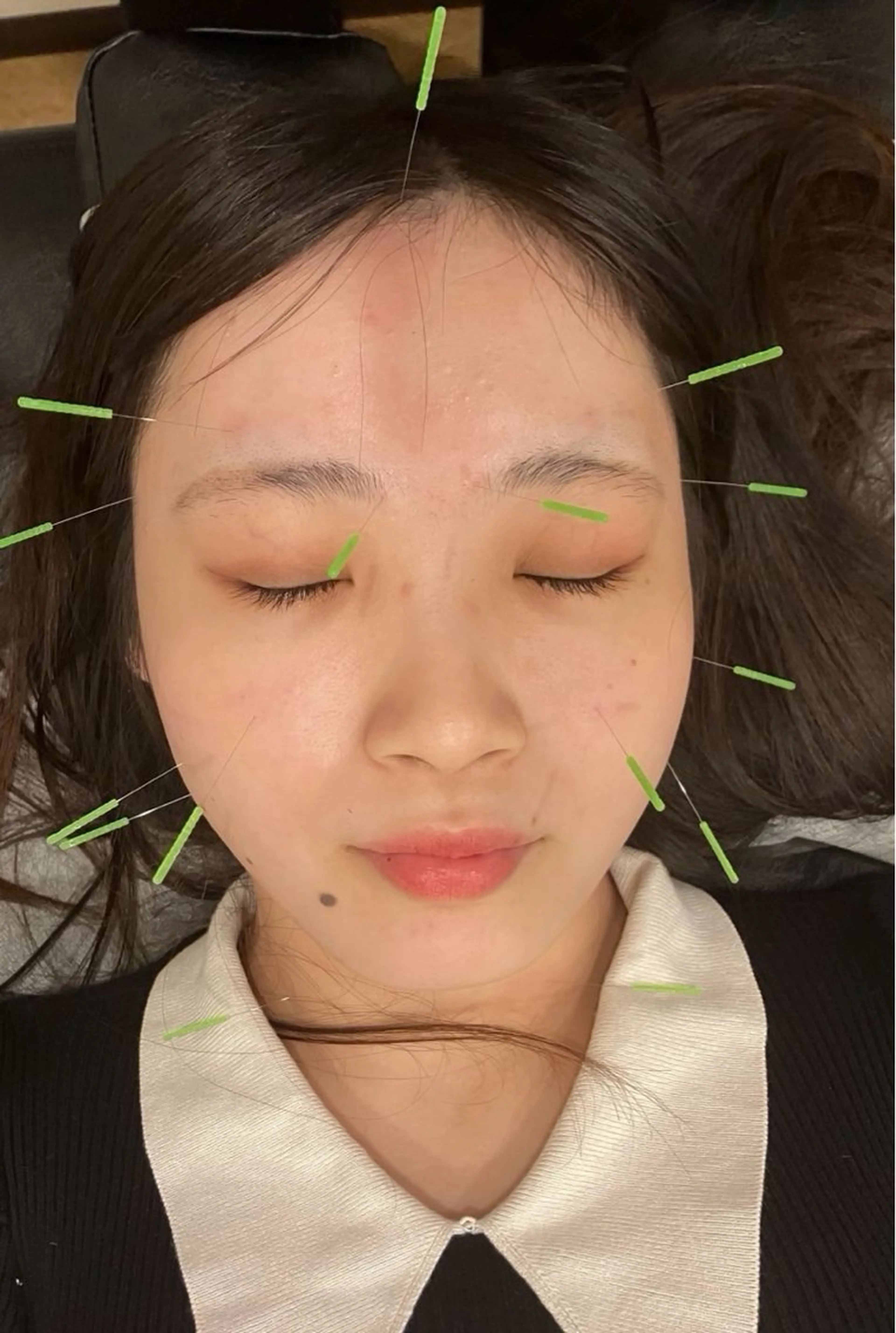 【人気No.1🌟】お試し美容鍼30分💖お悩みに合わせて施術します‼️の写真