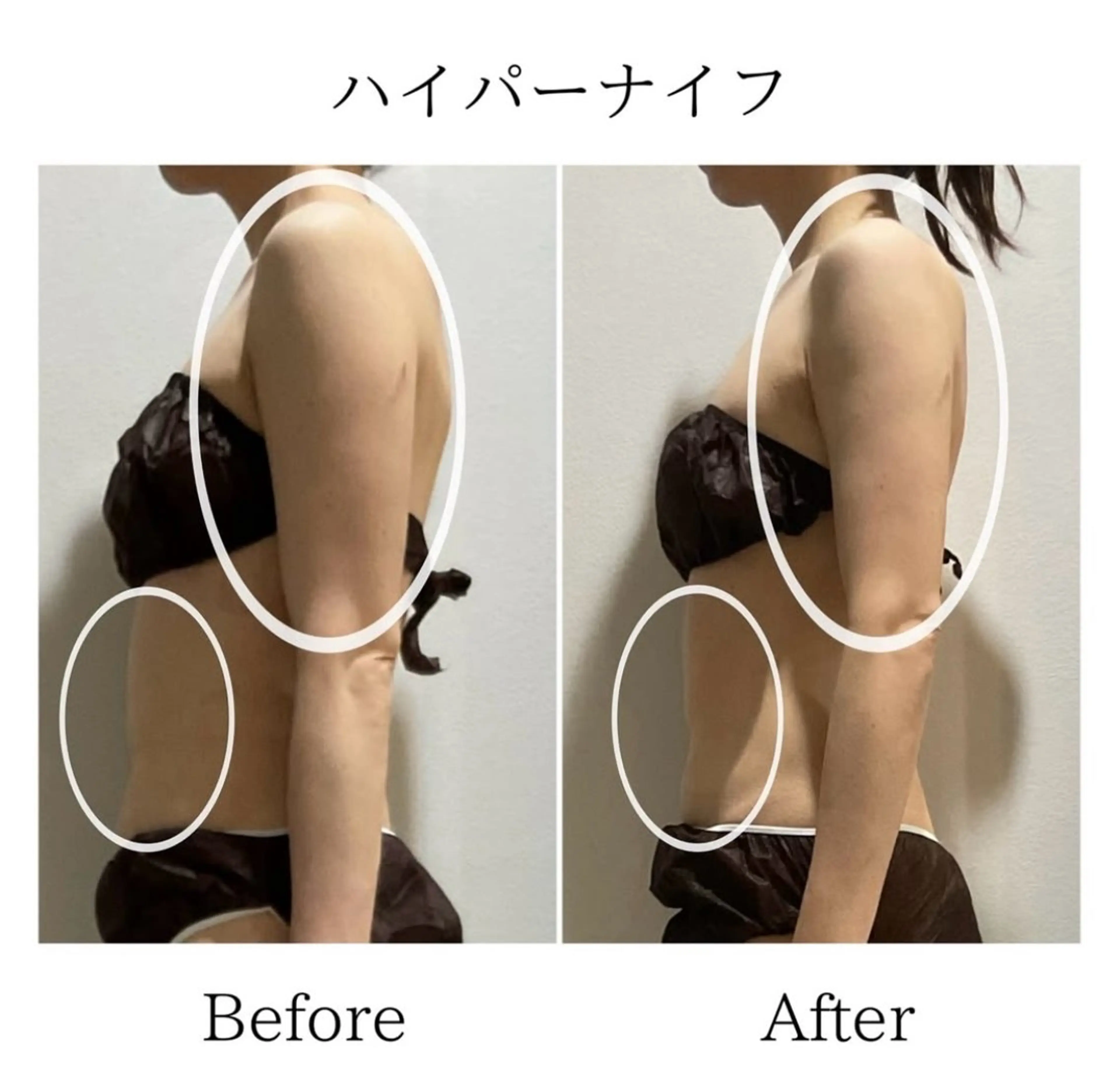 【二の腕痩せ★】振り袖二の腕卒業！　¥12,100→3,600の写真
