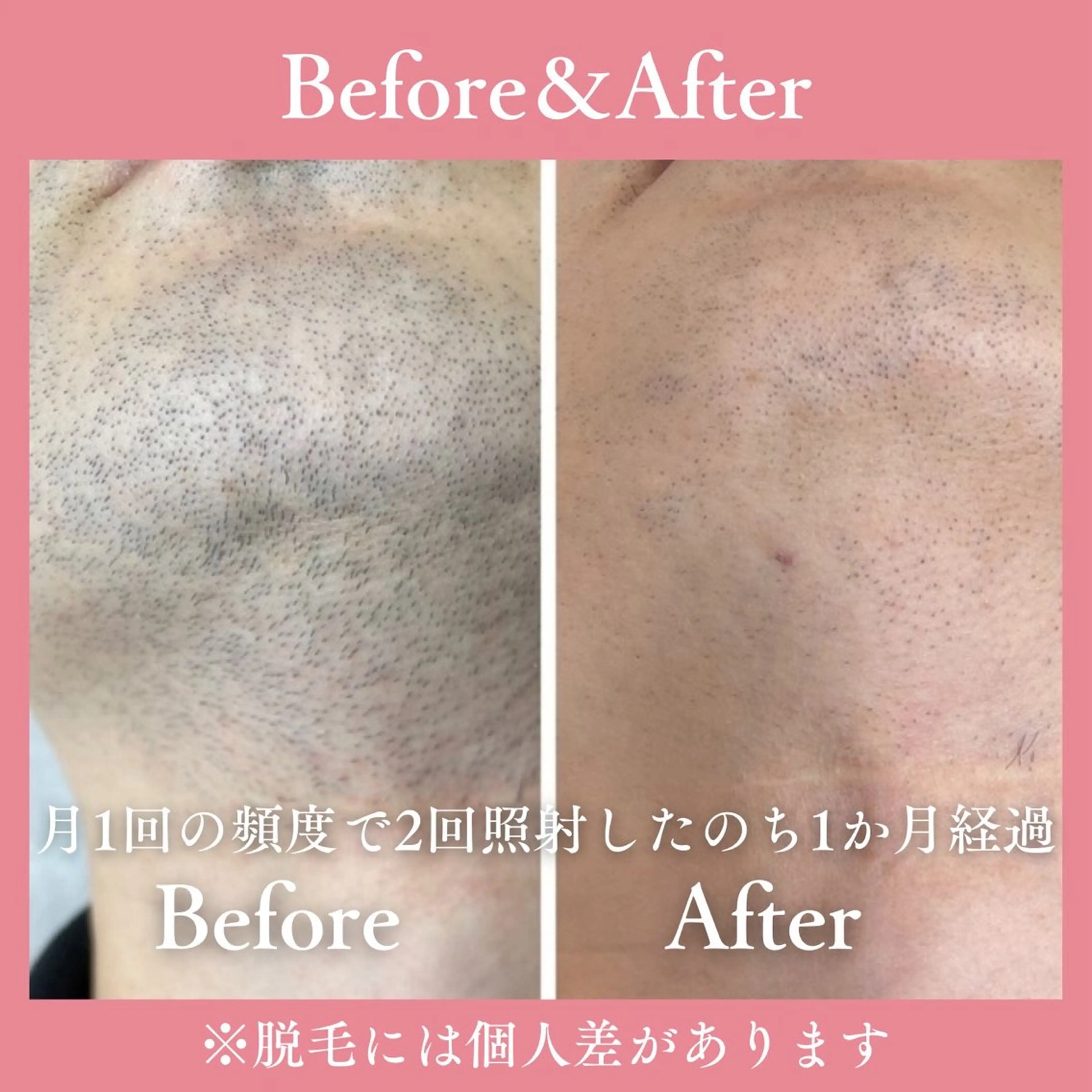 メンズ 有人型セルフサロン 脱毛/痩身/美顔のその他イメージ