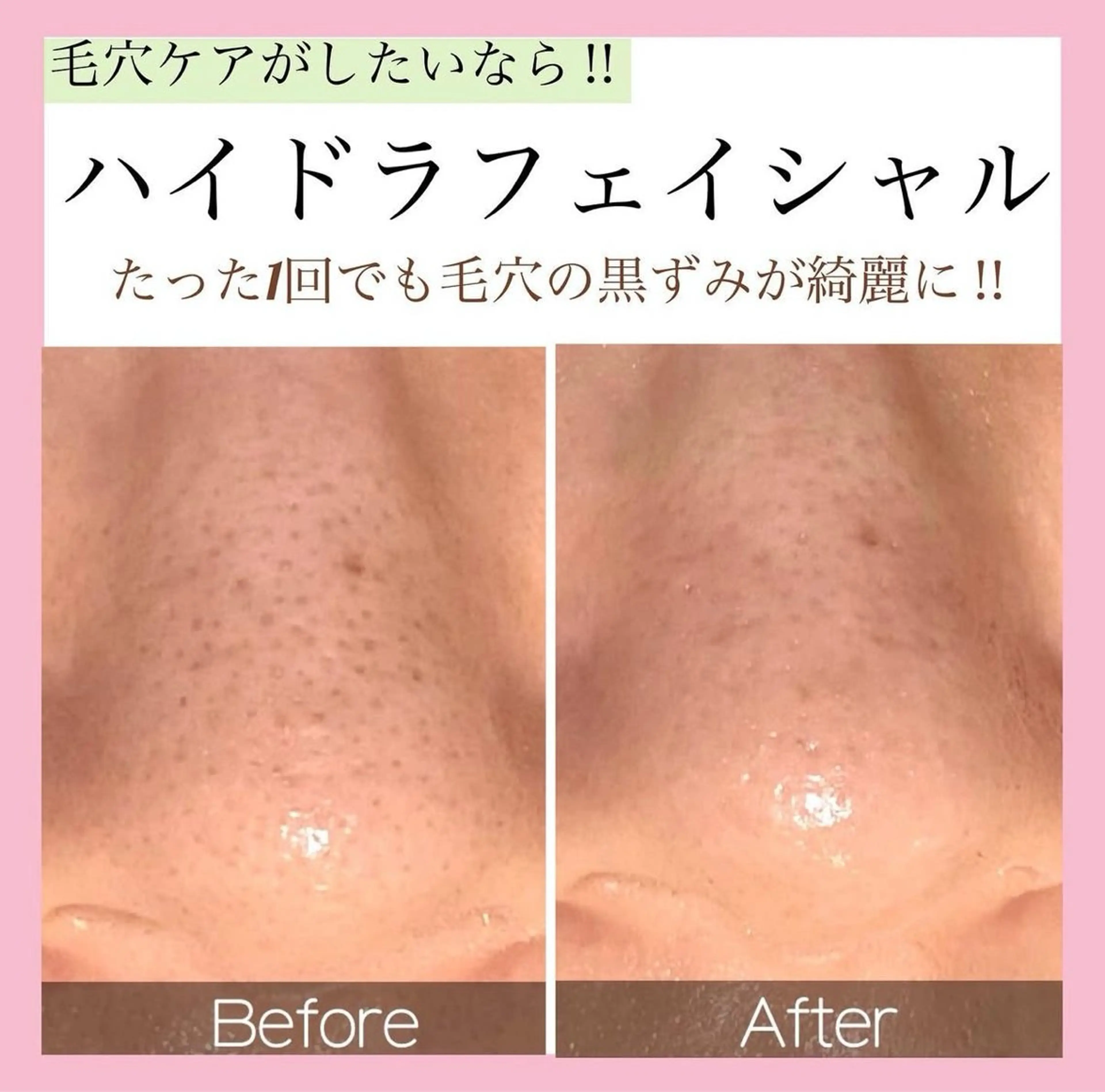 【毛穴洗浄🫧】人気NO.1 ハイドラフェイシャル✨の写真