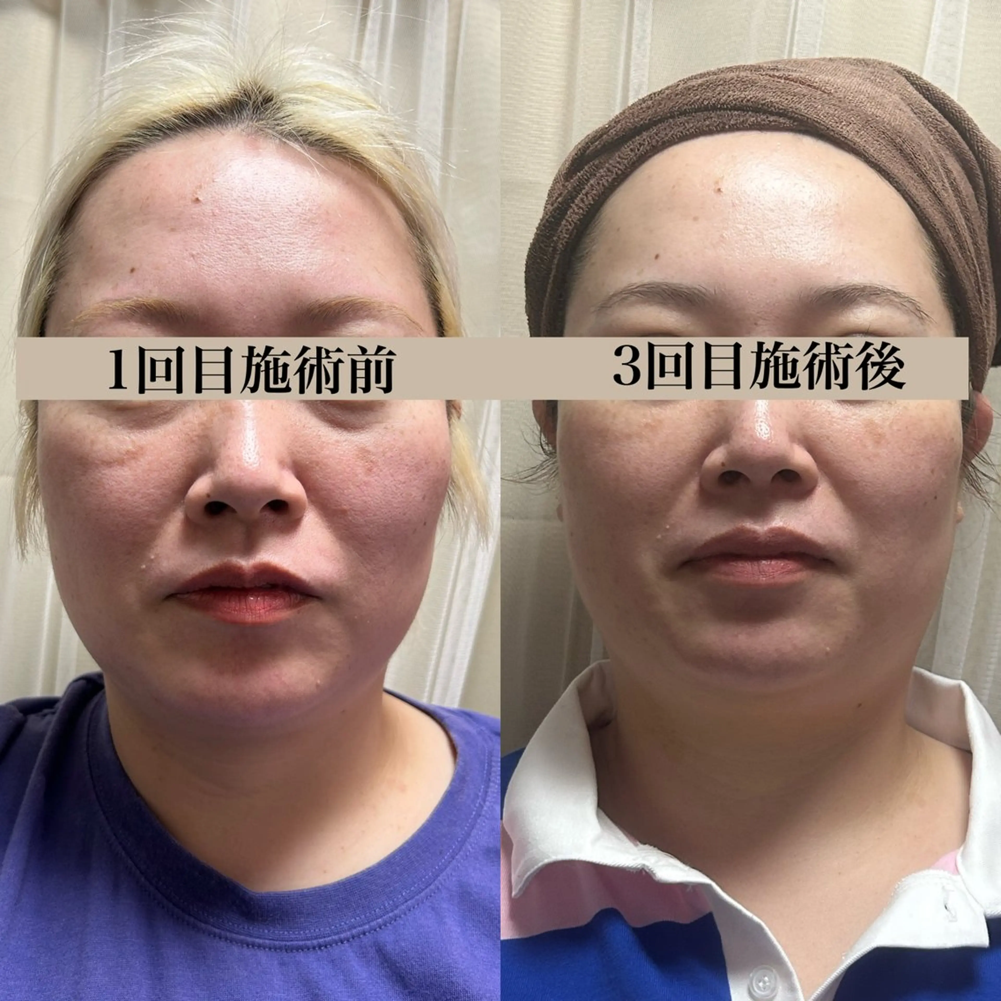 たるみに悩む大人肌へ筋肉からの引き上げケアの写真