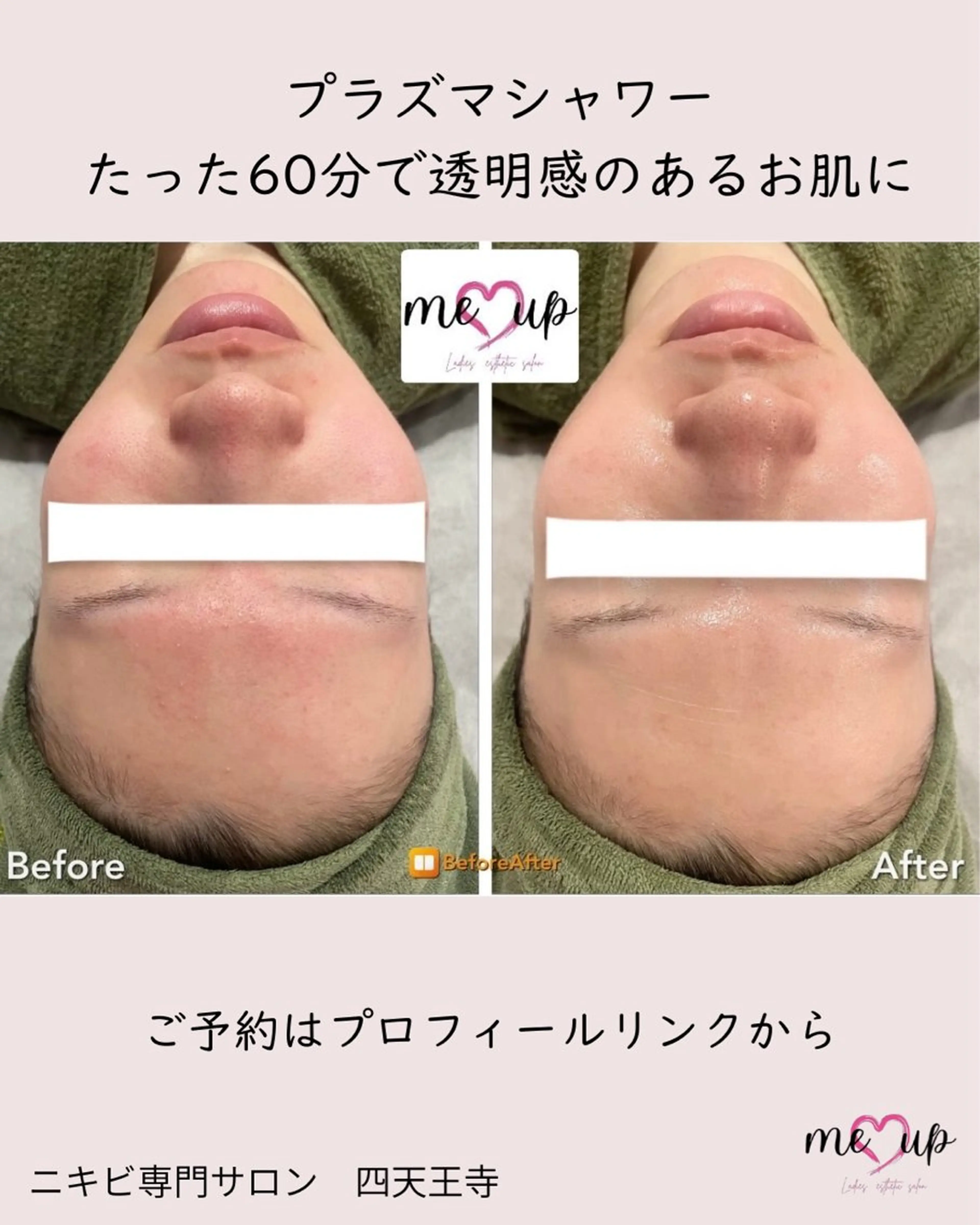 エステ Meupニキビ専門店 背中/ハーブ/肌管理のその他イメージ