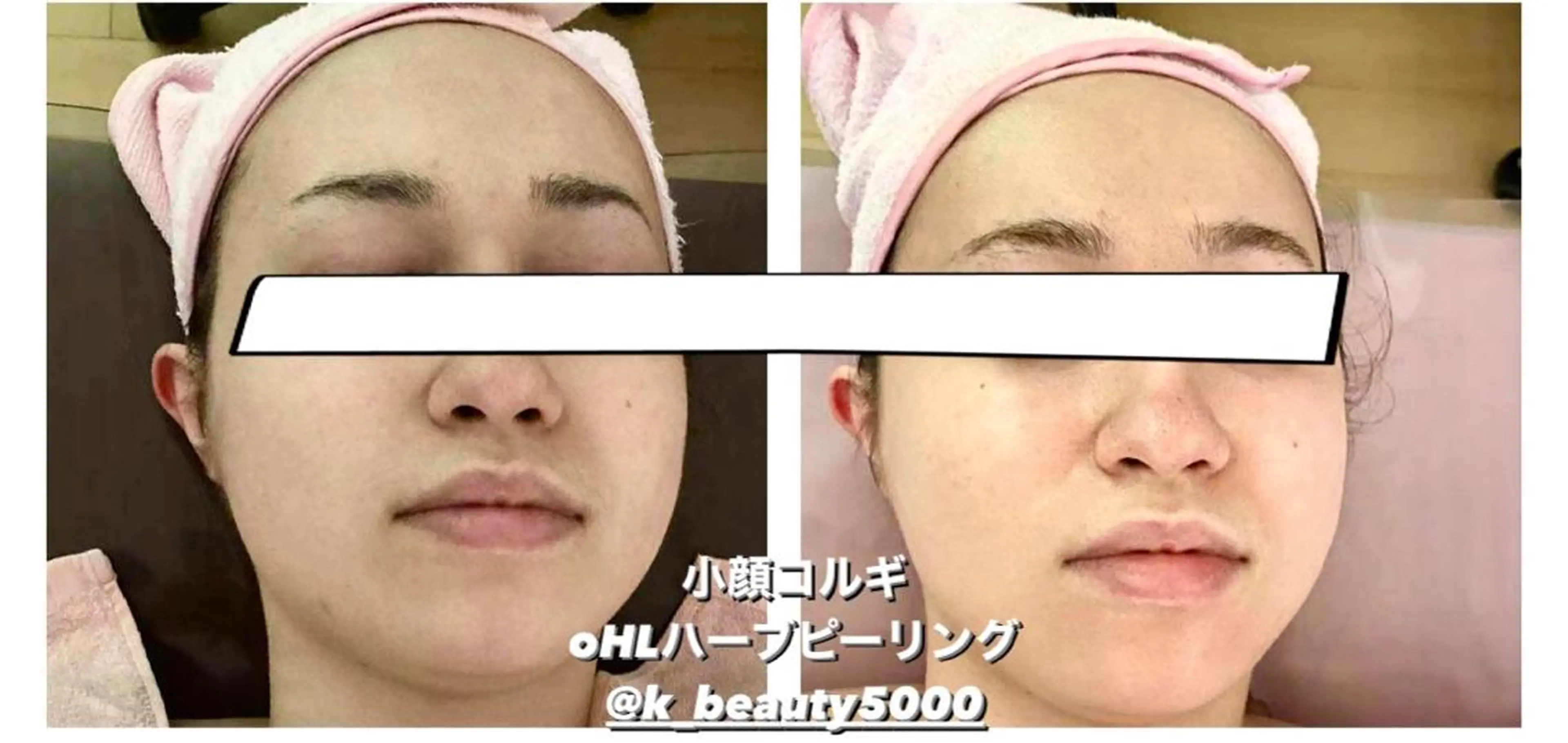 【ハイパーナイフ痩身&小顔コルギ&ハーブピーリング】K-Beauty　東新宿所属・kーbeauty痩身 フェイシャルのエステ・リラクイメージ