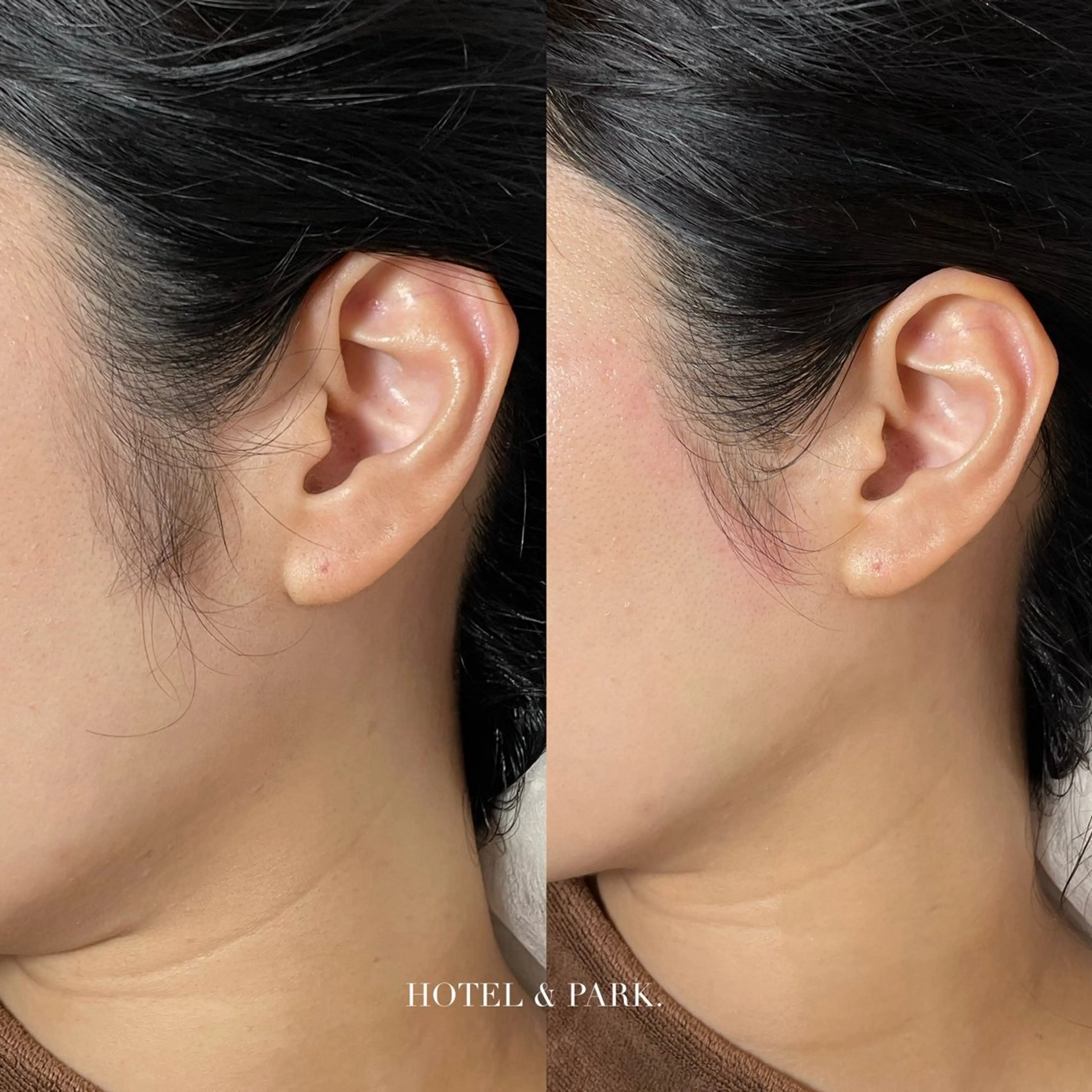 脱毛 HOTEL&PARK . ワックス脱毛のエステ・リラクイメージ