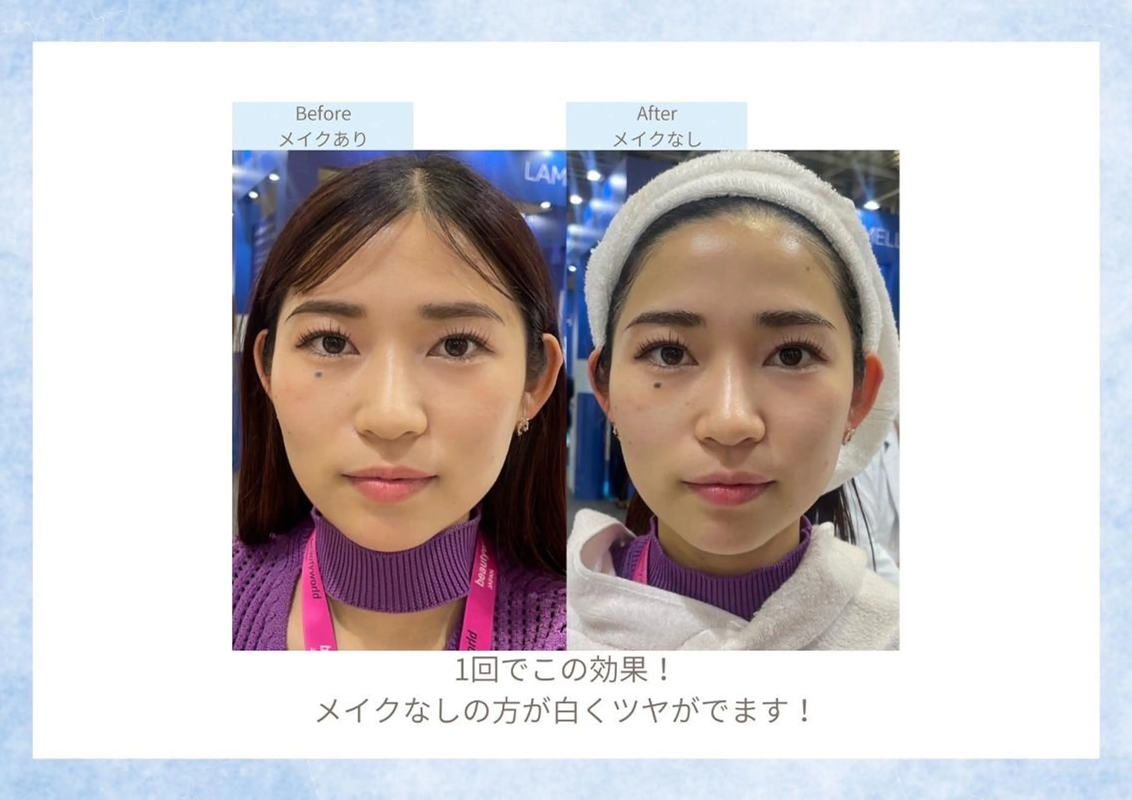 ⭐土日限定⭐【白玉ピーリング】白雪肌を目指す最強美白ケア✨シミ、毛穴、たるみ、しわをダウンタイムゼロで改善❕の写真