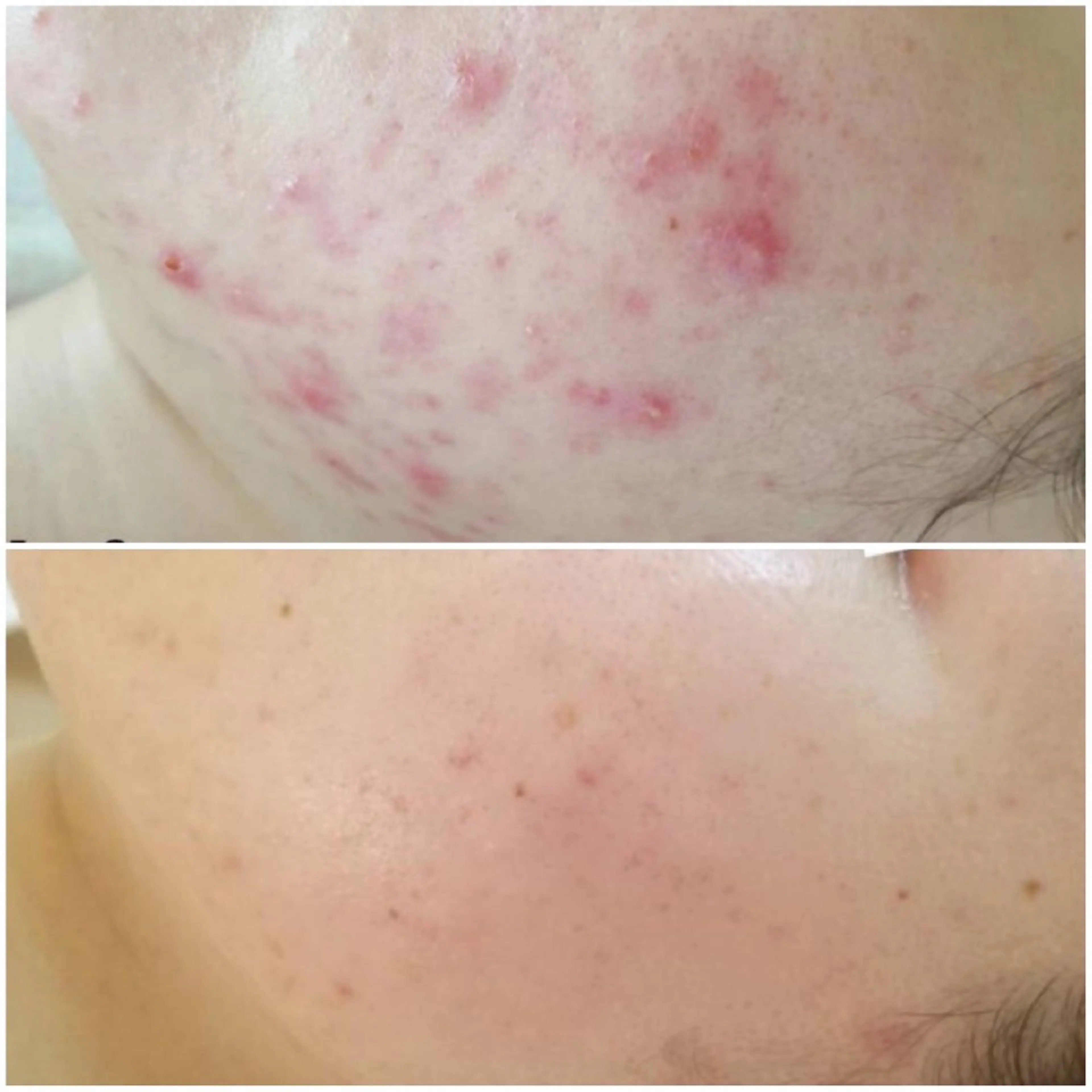 エステ ニキビケアサロン|Motorihi【モトリヒ】所属・ニキビケア Moto rihi【モトリヒ】のエステ・リラクイメージ