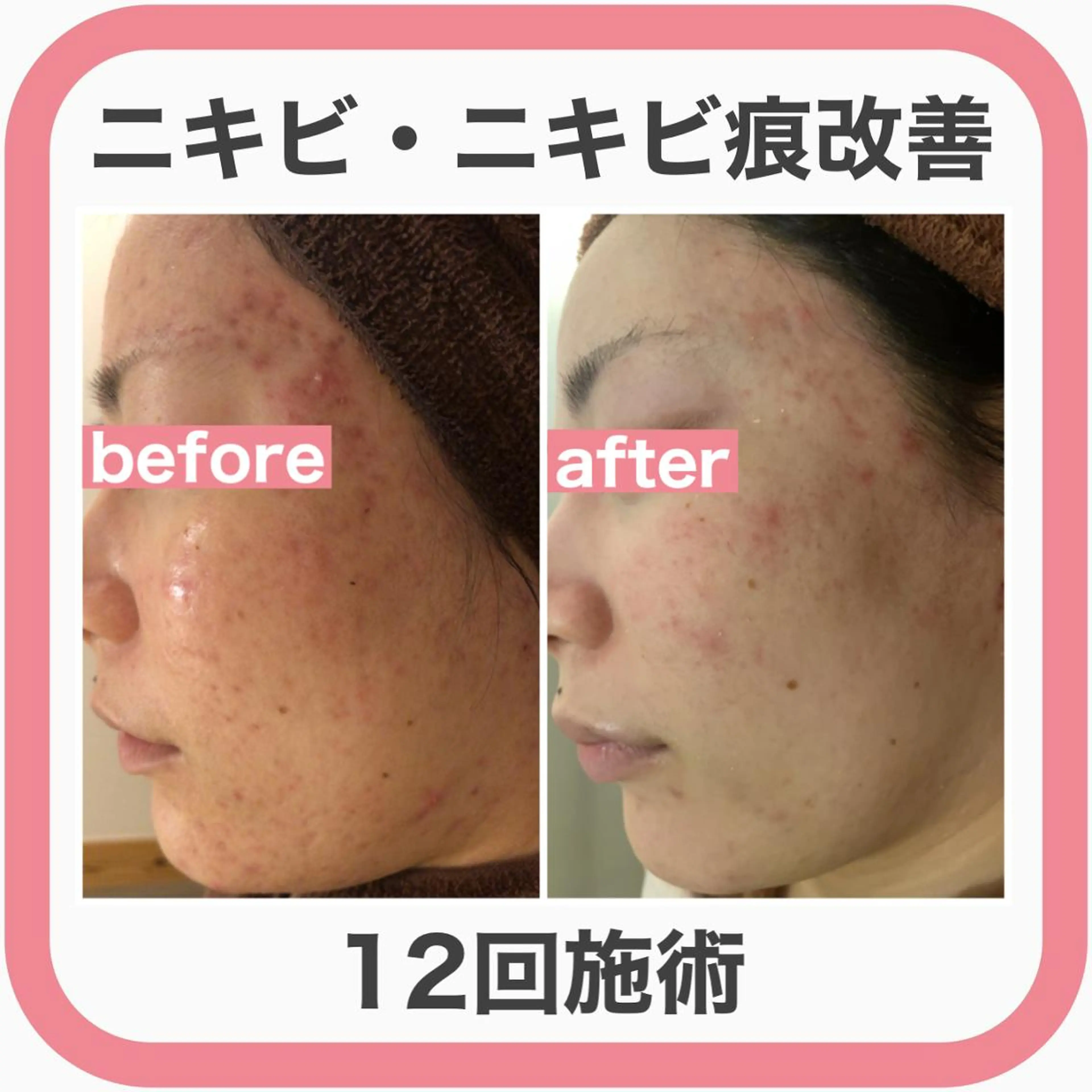 実績6万人🔥 超最速ニキビ改善のエステ・リラクイメージ