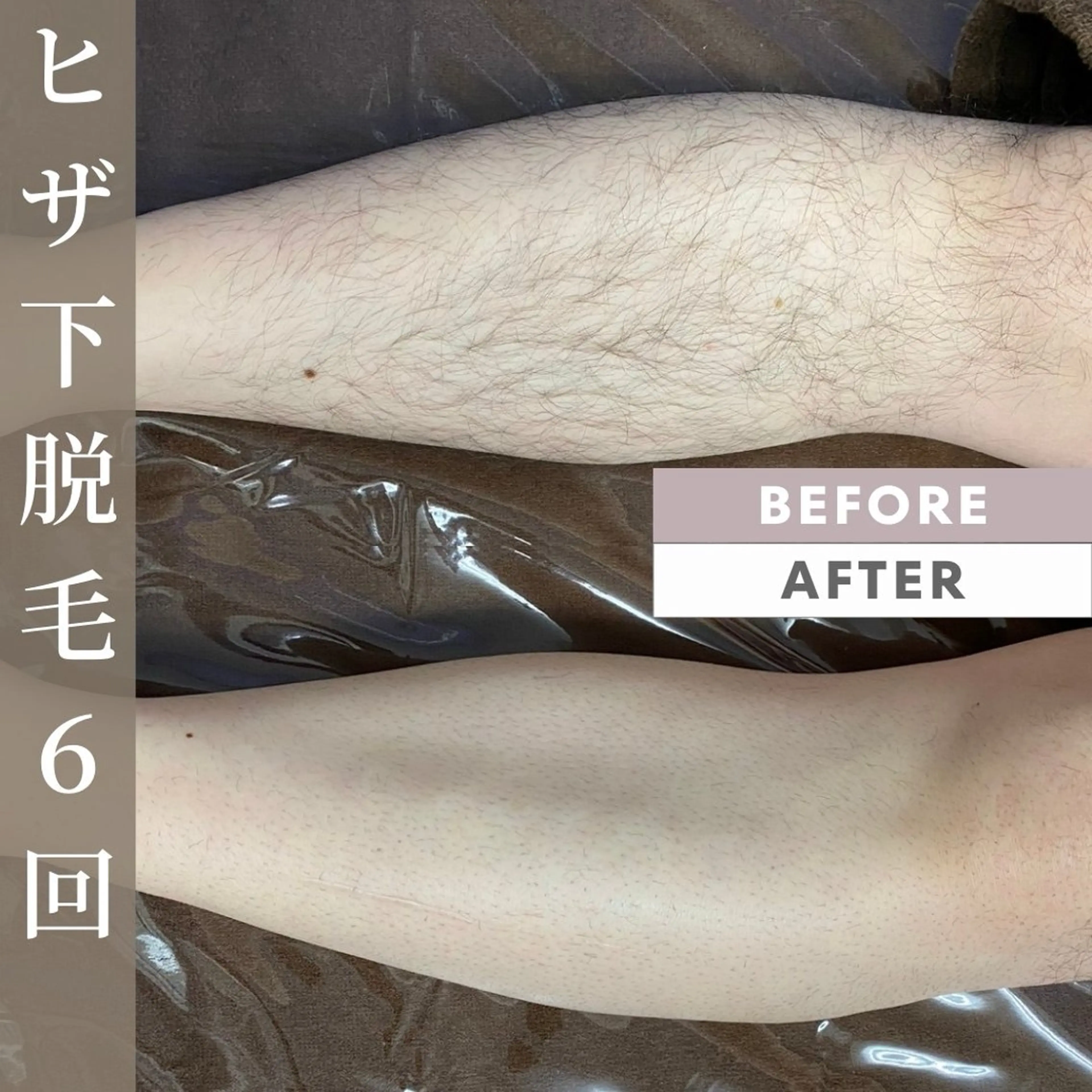 【メンズ脚脱毛】の写真