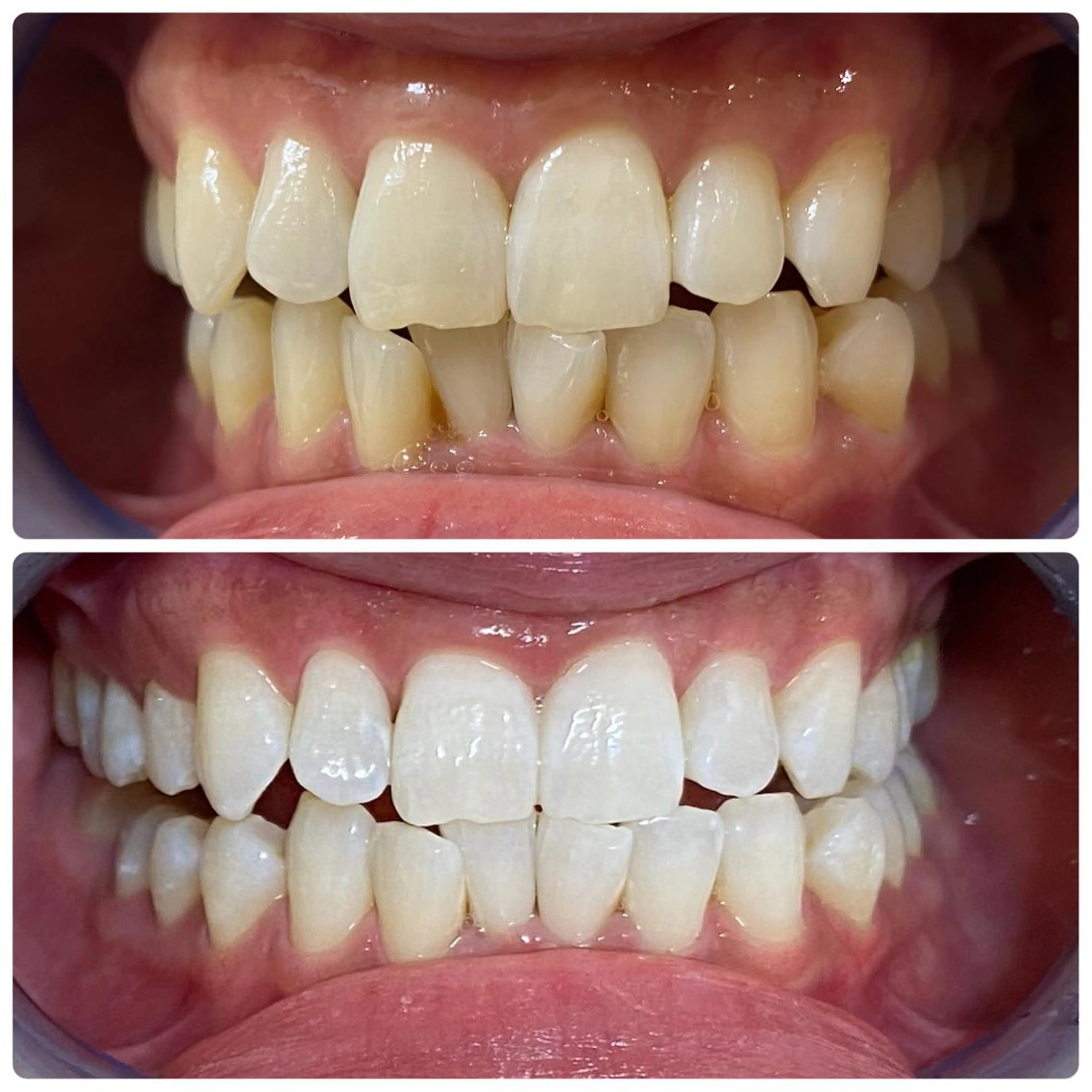 その他 White Berry SELF BEAUTY SALON所属・セルフホワイトニング 🦷口元垢抜け✨のその他イメージ