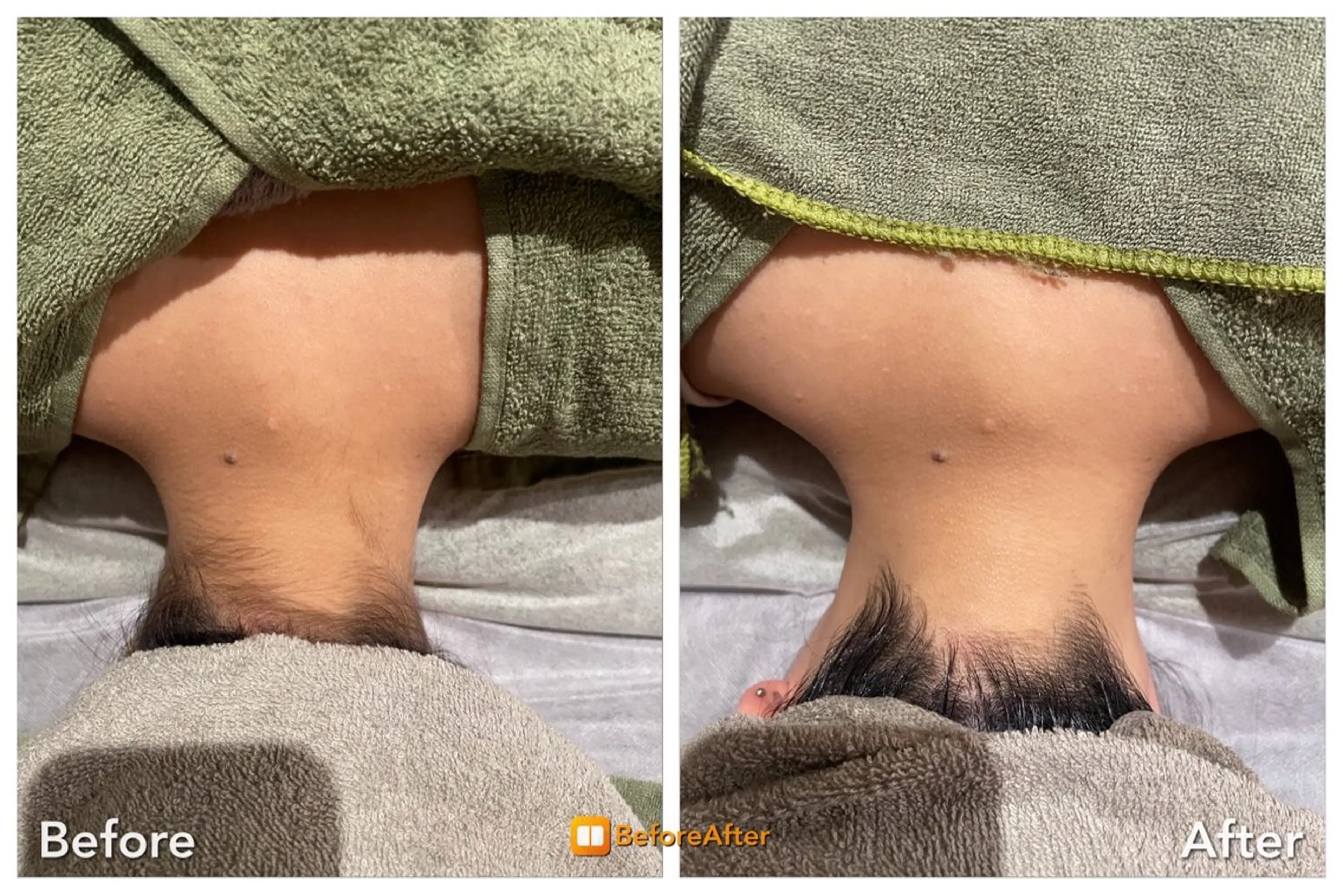 Meupニキビ専門店 背中/ハーブ/ララのその他イメージ