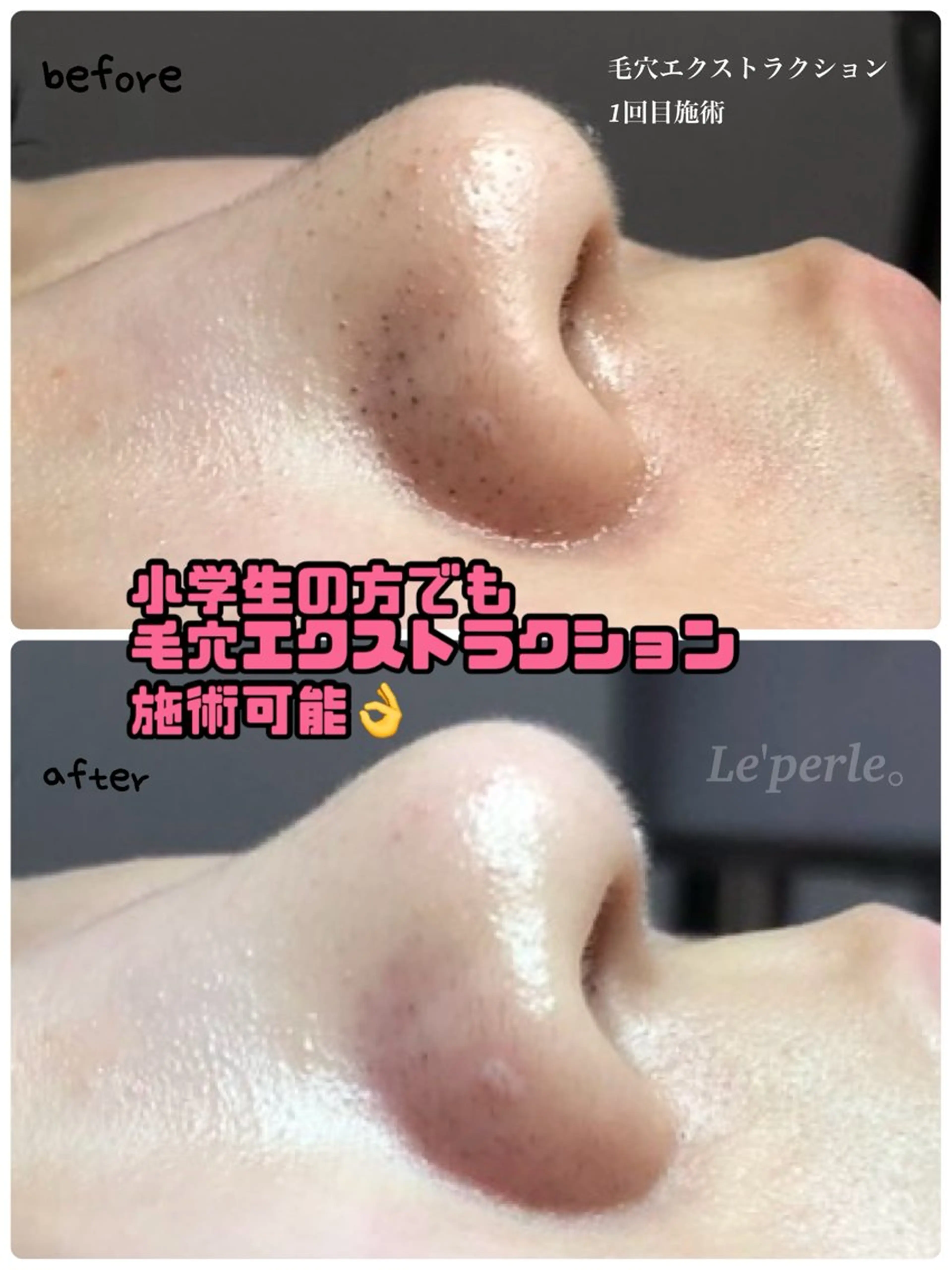 【ごっそり毛穴角栓】毛穴エクストラクション(鼻のみ)☆モニター様募集☆の写真