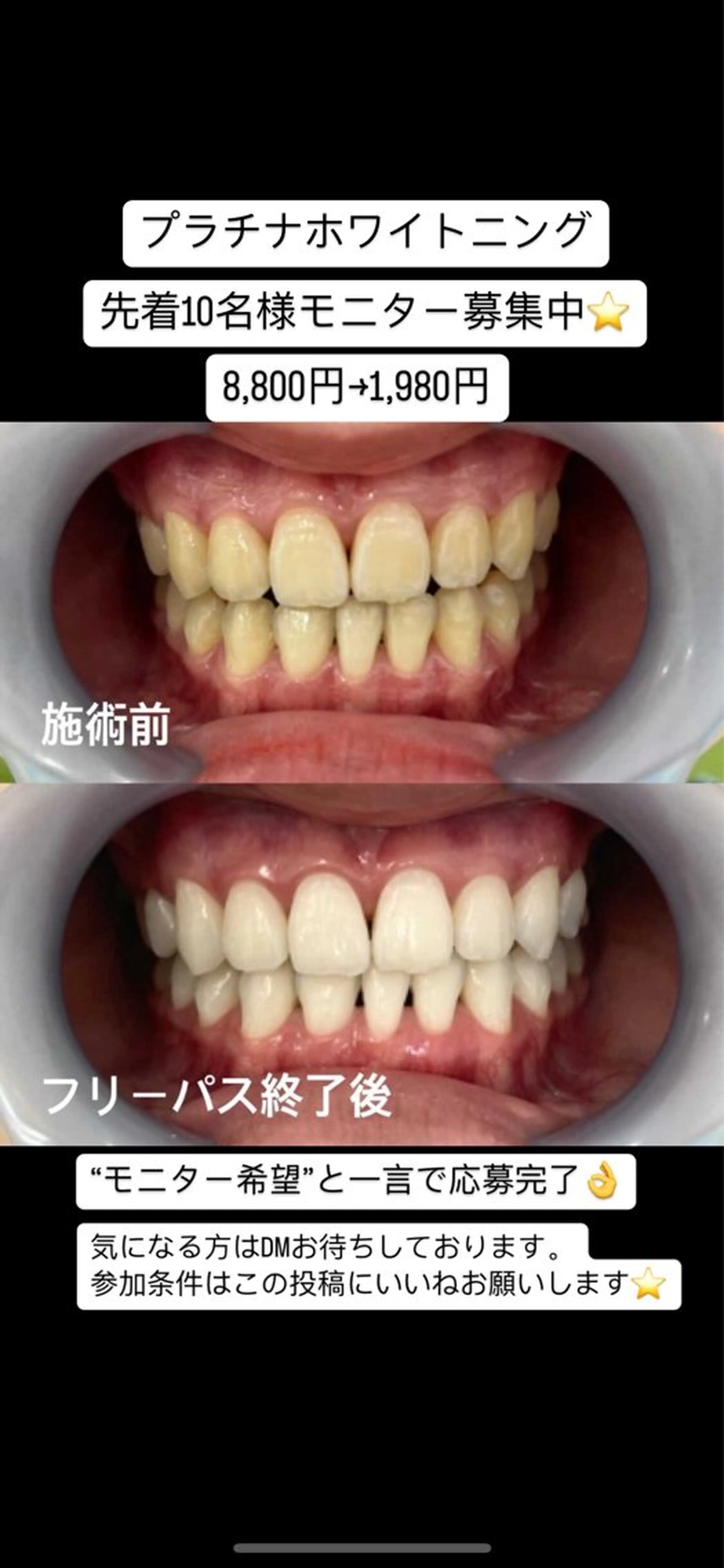 その他 セルフホワイトニング　アデル所属・戸嶋 菫のエステ・リラクイメージ