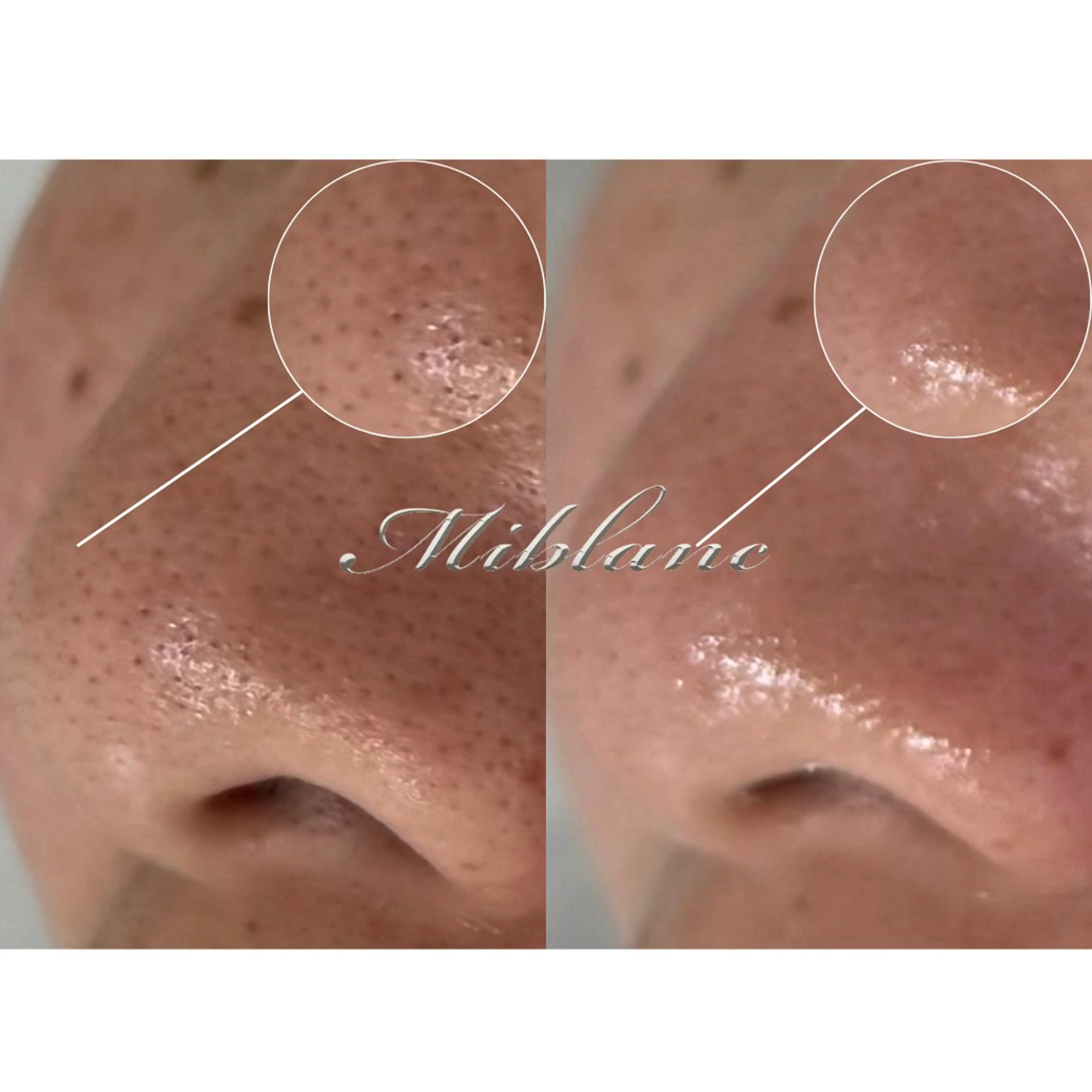 11月𝘤𝘢𝘮𝘱𝘢𝘪𝘯🍂《角栓/黒ずみ/開き毛穴》毛穴洗浄+全顔毛穴ケアマスク 通常価格¥7,000→の写真