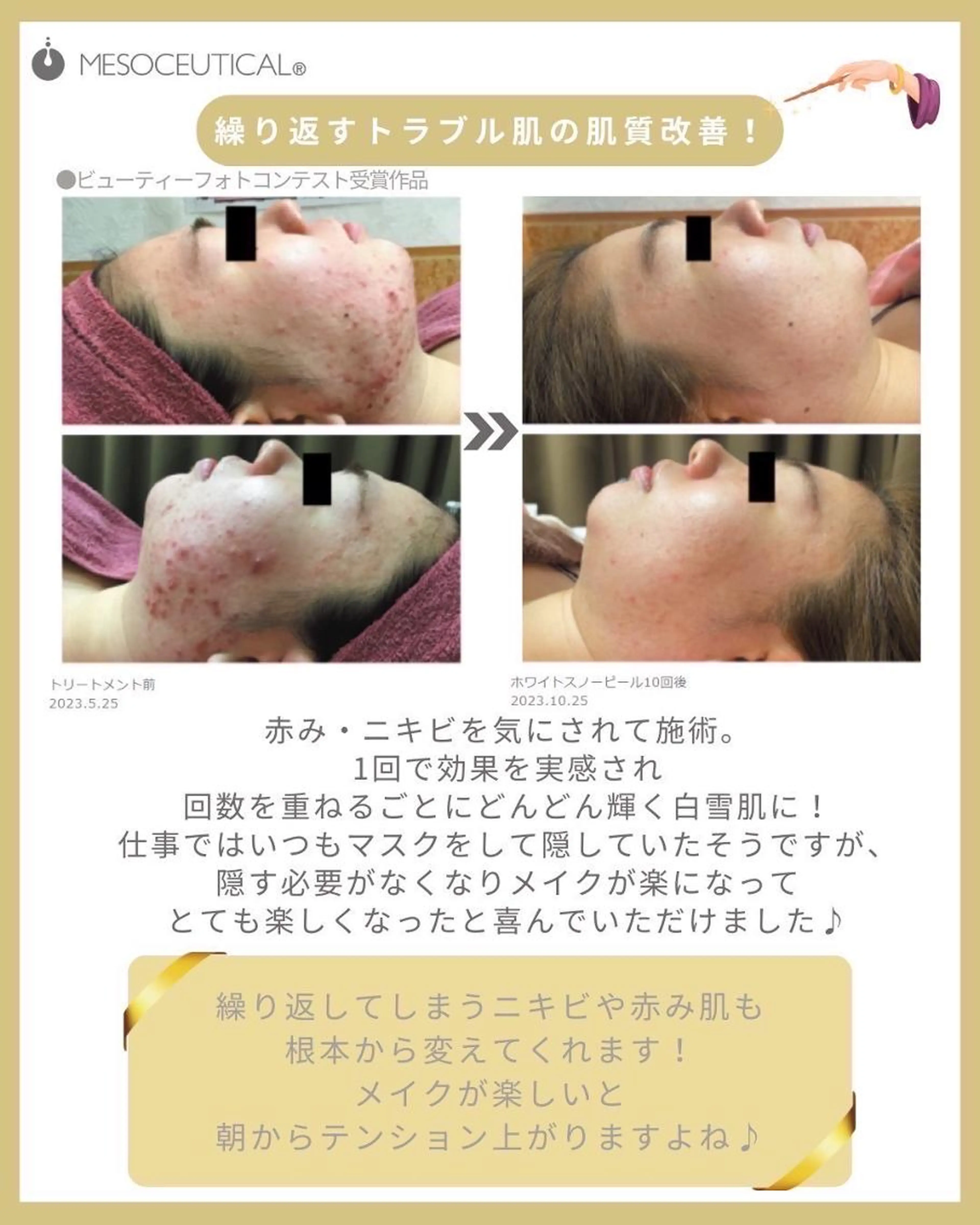 ホワイトスノーピール　1回の写真