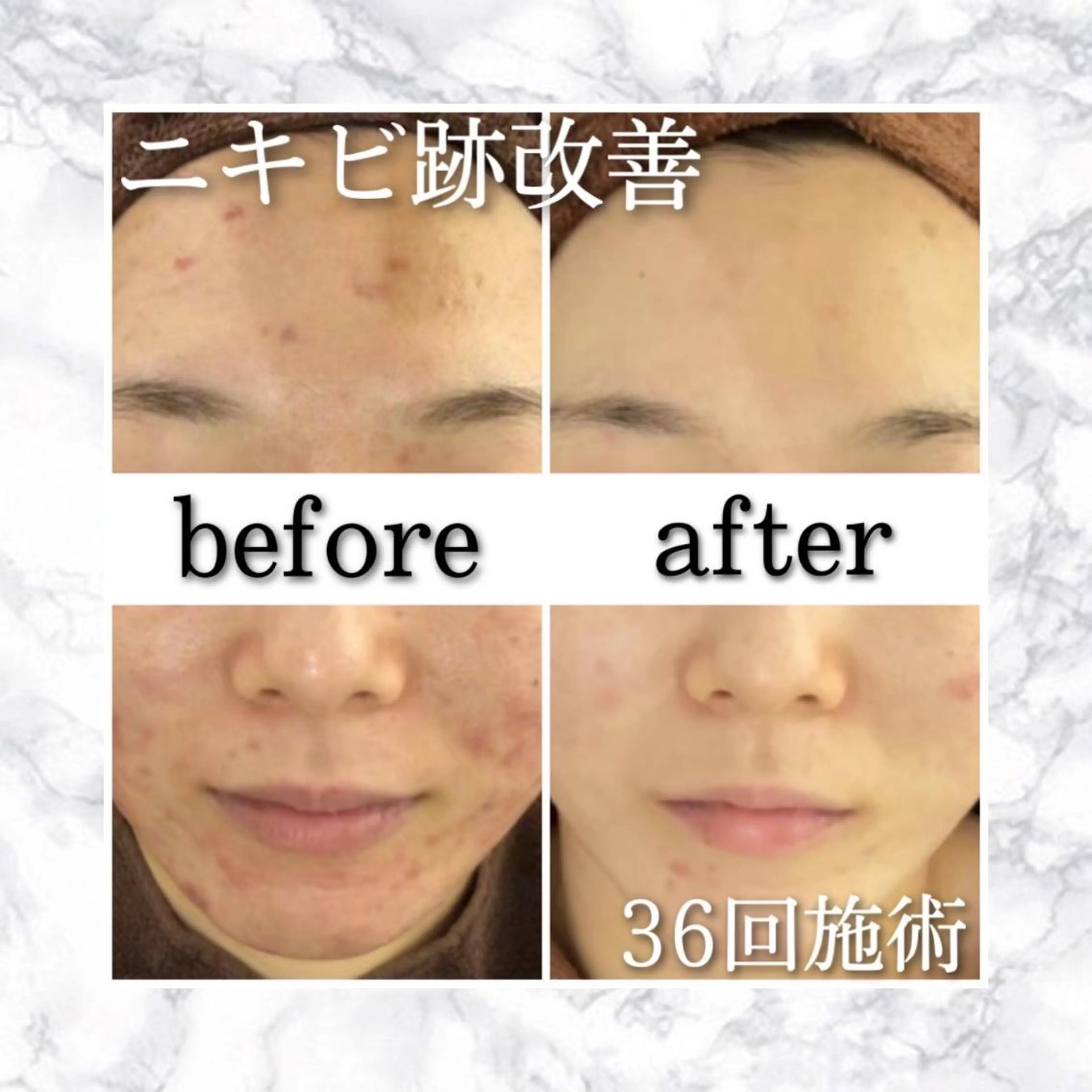セミロング カラー パーマ ヘアアレンジ メンズ キッズ ネイル マツエク・マツパ アイブロウ ニキビ特化型エステ 🍋最短で肌質改善のエステ・リラクイメージ