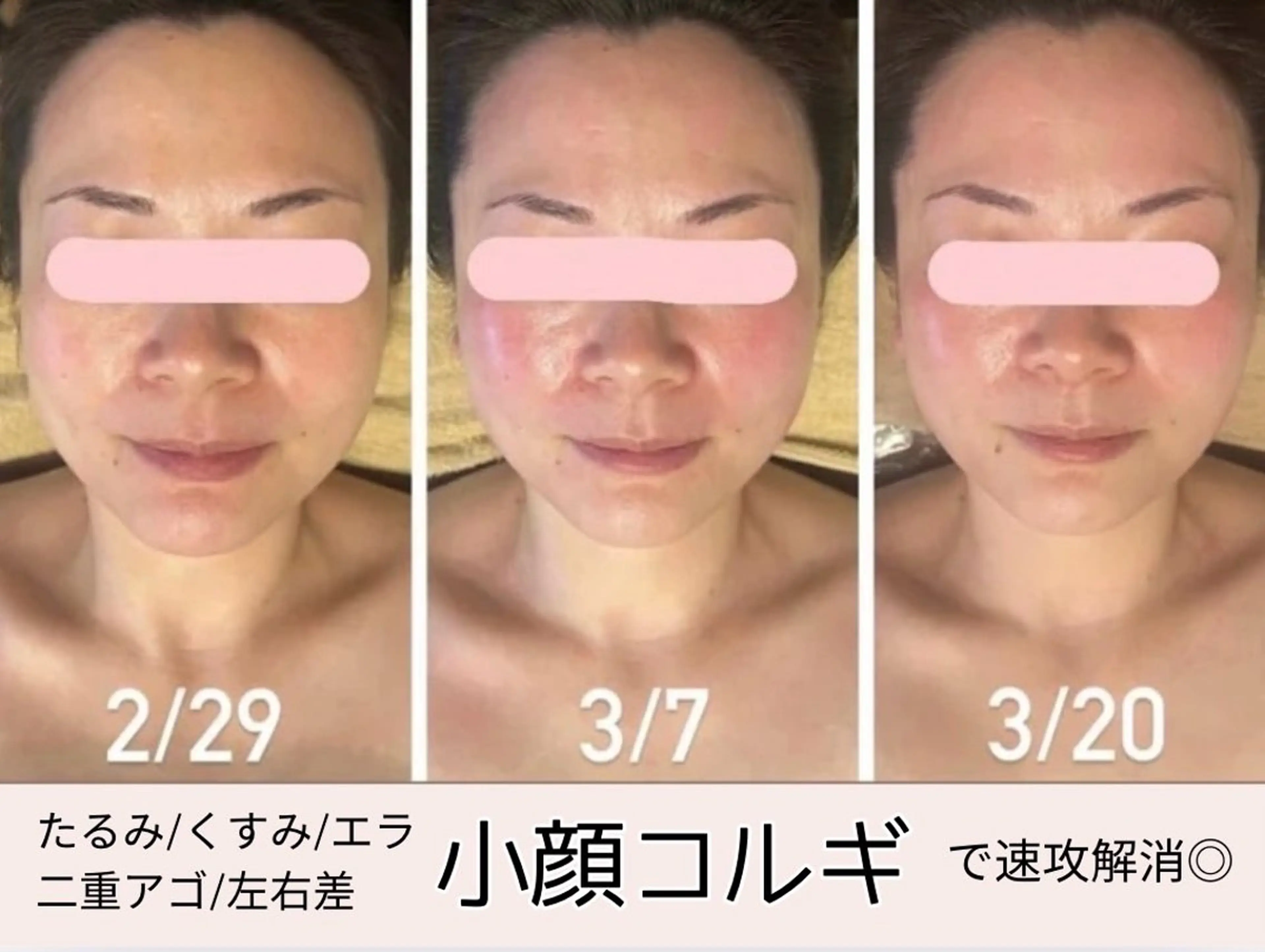 【女性限定】即効性抜群❣️小顔コルギ💆🏻♀️モデル様募集💛45分✨むくみスッキリ✨肩や首こりも同時に解消☺️の写真